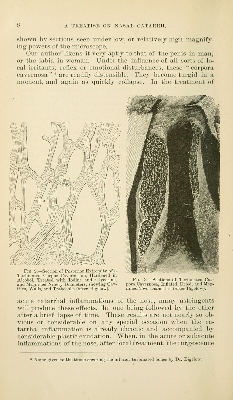 shown by sections seen under low. or relatively high magnify- ing powers of the microscope. Our author likens it very aptly to that of the penis in man, or the labia in woman. Under the influence of all sorts of lo- cal irritants', reflex or emotional disturbances, these corpora cavernosa * are readily distensible. They become turgid in a moment, and again as quickly collapse. In the treatment of Fig. 3.—Section of Posterior Extremity of a Tuxbinated Corpus Cavernosum, Hardened in Alcohol, Treated with Iodine and Glycerine, and Magnified Ninety Diameters, showing Cav- ities, WaUs, and Tralaeculse (after Bigelow). Pig. 3.—Sections of Turbinated Cor- pora Cavernosa, Inflated, Dried, aud Mag- nified Two Diameters (after Bigelow). acute catarrhal inflammations of the nose, many astringents will produce these effects, the one being followed by the other after a brief lapse of time. These results are not nearly so ob- vious or considerable on any special occasion when the ca- tarrhal inflammation is already chronic and accompanied by considerable i3lastic exudation. When, in the acute or subacute inflammations of the nose, after local treatment, the turgescence * Name given to the tissue covering the inferior turbinated bones by Dr. Bigelow.