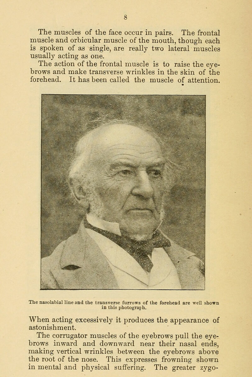 The muscles of the face occur in pairs. The frontal muscle and orbicular muscle of the mouth, though each is spoken of as single, are really two lateral muscles usually acting as one. The action of the frontal muscle is to raise the eye- brows and make transverse wrinkles in the skin of the forehead. It has been called the muscle of attention. The nasolabial line and the transverse furrows of the forehead are well shown in this photograph. When acting excessively it produces the appearance of astonishment. The corrugator muscles of the eyebrows pull the eye- brows inward and downward near their nasal ends, making vertical wrinkles between the eyebrows above the root of the nose. This expresses frowning shown in mental and physical suffering. The greater zygo-