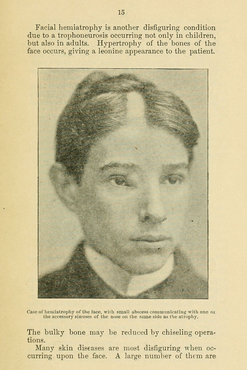 Facial hemiatrophy is another disfiguring condition due to a trophoneurosis occurring not only in children, but also in adults. Hypertrophy of the bones of the face occurs, giving a leonine appearance to the patient. Case of hemiatrophy of the face, with small abscess communicating with one oi the accessory sinuses of the nose on the same side as the atrophy. The bulky bone may be reduced by chiseling opera- tions. Many skin diseases are most disfiguring when oc- curring upon the face. A large number of them are