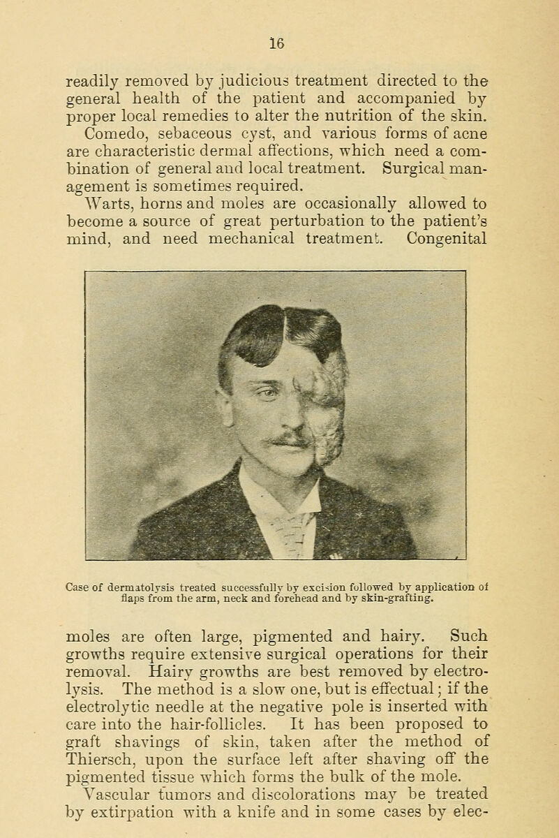 readily removed by judicious treatment directed to the general health of the patient and accompanied by proper local remedies to alter the nutrition of the skin. Comedo, sebaceous cyst, and various forms of acne are characteristic dermal affections, which need a com- bination of general and local treatment. Surgical man- agement is sometimes required. Warts, horns and moles are occasionally allowed to become a source of great perturbation to the patient's mind, and need mechanical treatment. Congenital Case of dennatolysis treated successfully by excision followed by application of flaps from the arm, neck and forehead and by skin-grafting. moles are often large, pigmented and hairy. Such growths require extensive surgical operations for their removal. Hairy growths are best removed by electro- lysis. The method is a slow one, but is effectual; if the electrolytic needle at the negative pole is inserted with care into the hair-follicles. It has been proposed to graft shavings of skin, taken after the method of Thiersch, upon the surface left after shaving off the pigmented tissue which forms the bulk of the mole. Vascular tumors and discolorations may be treated by extirpation with a knife and in some cases by elec-