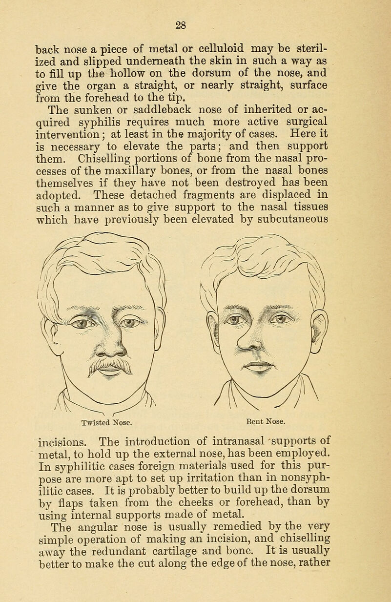 back nose a piece of metal or celluloid may be steril- ized and slipped underneath the skin in such a way as to fill up the hollow on the dorsum of the nose, and give the organ a straight, or nearly straight, surface from the forehead to the tip. The sunken or saddleback nose of inherited or ac- quired syphilis requires much more active surgical intervention; at least in the majority of cases. Here it is necessary to elevate the parts; and then support them. Chiselling portions of bone from the nasal pro- cesses of the maxillary bones, or from the nasal bones themselves if they have not been destroyed has been adopted. These detached fragments are displaced in such a manner as to give support to the nasal tissues which have previously been elevated by subcutaneous Twisted Nose. Bent Nose. incisions. The introduction of intranasal -supports of metal, to hold up the external nose, has been employed. In syphilitic cases foreign materials used for this pur- pose are more apt to set up irritation than in nonsyph- ilitic cases. It is probably better to build up the dorsum by flaps taken from the cheeks or forehead, than by using internal supports made of metal. The angular nose is usually remedied by the very simple operation of making an incision, and chiselling away the redundant cartilage and bone. It is usually better to make the cut along the edge of the nose, rather