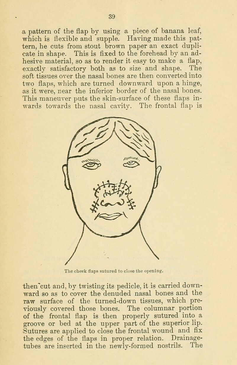 a pattern of the flap by using a piece of banana leaf, which is flexible and supple. Having made this pat- tern, he cuts from stout brown paper an exact dupli- cate in shape. This is fixed to the forehead by an ad- hesive materia], so as to render it easy to make a flap, exactly satisfactory both as to size and shape. The soft tissues over the nasal bones are then converted into two flaps, which are turned downward upon a hinge, as it were, near the inferior border of the nasal bones. This maneuver puts the skin-surface of these flaps in- wards towards the nasal cavity. The frontal flap is ^^ The cheek flaps sutured to close the opening. then'cut and, by twisting its pedicle, it is carried down- ward so as to cover the denuded nasal bones and the raw surface of the turned-down tissues, which pre- viously covered those bones. The columnar portion of the frontal flap is then properly sutured into_ a groove or bed at the upper part of the superior lip. Sutures are applied to close the frontal wound and fix the edges of the flaps in proper relation. Drainage- tubes are inserted in the newly-formed nostrils. The