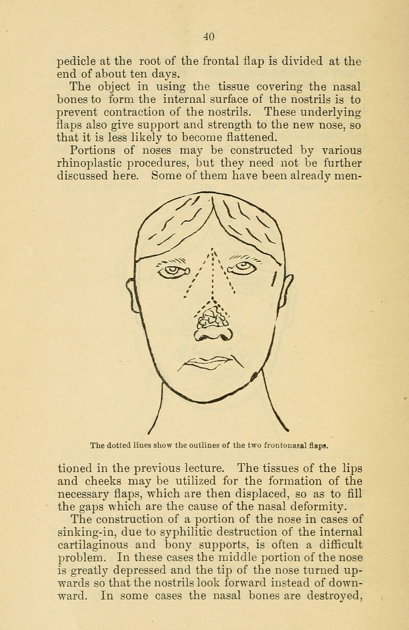 pedicle at the root of the frontal flap is divided at the end of about ten days. The object in using the tissue covering the nasal bones to form the internal surface of the nostrils is to prevent contraction of the nostrils. These underlying flaps also give support and strength to the new nose, so that it is less likely to beconae flattened. Portions of noses may be constructed by various rhinoplastic procedures, but they need not be further discussed here. Some of them have been already men- The dotted lines show the outlines of the two frontonasal flaps. tioned in the previous lecture. The tissues of the lips and cheeks may be utilized for the formation of the necessary flaps, which are then displaced, so as to fill the gaps which are the cause of the nasal deformity. The construction of a portion of the nose in cases of sinking-in, due to syphilitic destruction of the internal cartilaginous and bony supports, is often a difiicult problem. In these cases the middle portion of the nose is greatly depressed and the tip of the nose turned up- wards so that the nostrils look forward instead of down- ward. In some cases the nasal bones are destroyed,