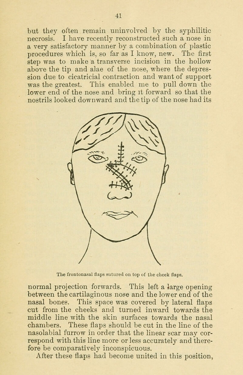 but they often remain uninvolved by the syphilitic necrosis. I have recently reconstructed such a nose in a very satisfactory manner by a combination of plastic procedures which is, so far as I know, new. The first step was to make a transverse incision in the hollow above the tip and alae of the nose, where the depres- sion due to cicatricial contraction and want of support was the greatest. This enabled me to pull down the lower end of the nose and bring it forward so that the nostrils looked downward and the tip of the nose had its The frontonasal flaps sutured on top of the cheek flaps. normal projection forwards. This left a large openiDg between the cartilaginous nose and the lower end of the nasal bones. This space was covered by lateral flaps cut from the cheeks and turned inward towards the middle line with the skin surfaces towards the nasal chambers. These flaps should be cut in the line of the nasolabial furrow in order that the linear scar may cor- respond with this line more or less accurately and there- fore be comparatively inconspicuous. After these flaps had become united in this position,