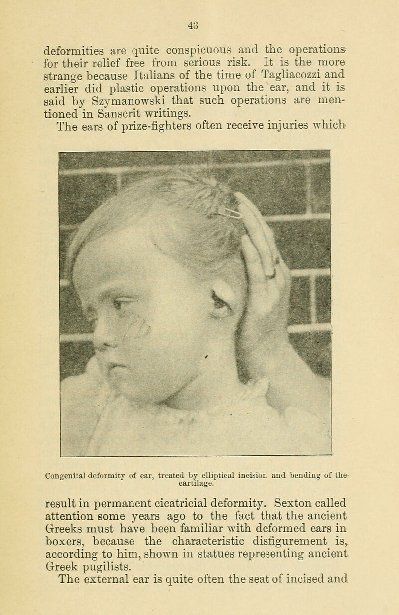 deformities are quite conspicuous and the operations for their relief free from serious risk. It is the more strange because Itahans of the time of Tagliacozzi and earlier did plastic operations upon the ear, and it is said by Szymanowski that such operations are men- tioned in Sanscrit writings. The ears of prize-fighters often receive injuries which Congenital deformity of ear, treated by elliptical incision and bending of the- cartilage. result in permanent cicatricial deformity. Sexton called attention some years ago to the fact that the ancient Greeks must have been familiar with deformed ears in boxers, because the characteristic disfigurement is^ according to him, shown in statues representing ancient Greek pugilists. The external ear is quite often the seat of incised and