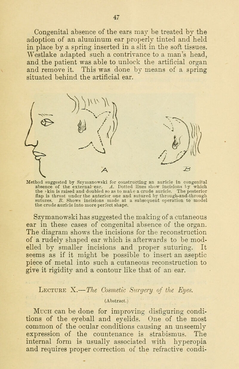 Congenital absence of the ears may be treated by the adoption of an aluminum ear properly tinted and held in place by a spring inserted in a slit in the soft tissues. Westlake adapted such a contrivance to a man's head, and the patient was able to unlock the artificial organ and remove it. This was done by means of a spring situated behind the artificial ear. Method suggested by Szymanowski for constructing an auricle in congenital absence of the external-'ear. A. Dotted lines show incisions by which the ^kin is raised and doubled so as to mate a crude auricle. The posterior flap is thrust under the anterior one and sutured by through-and-through sutures. B. Shoivs incisions made at a subsequent operation to model the crude auricle into more perfect shape. Szymanowski has suggested the making of a cutaneous ear in these cases of congenital absence of the organ. The diagram shows the incisions for the reconstruction of a rudely shaped ear which is afterwards to be mod- elled by smaller incisions and proper suturing. It seems as if it might be possible to insert an aseptic piece of metal into such a cutaneous reconstruction to give it risiditv and a contour like that of an ear. Lecture X.—The Cosmetic Surgery of the Eyes. (Abstract.) Much can be done for improving disfiguring condi- tions of the eyeball and eyelids. One of the most common of the ocular conditions causing an unseemly expression of the countenance is strabismus. The internal form is usually associated with hyperopia and requires proper correction of the refractive condi-