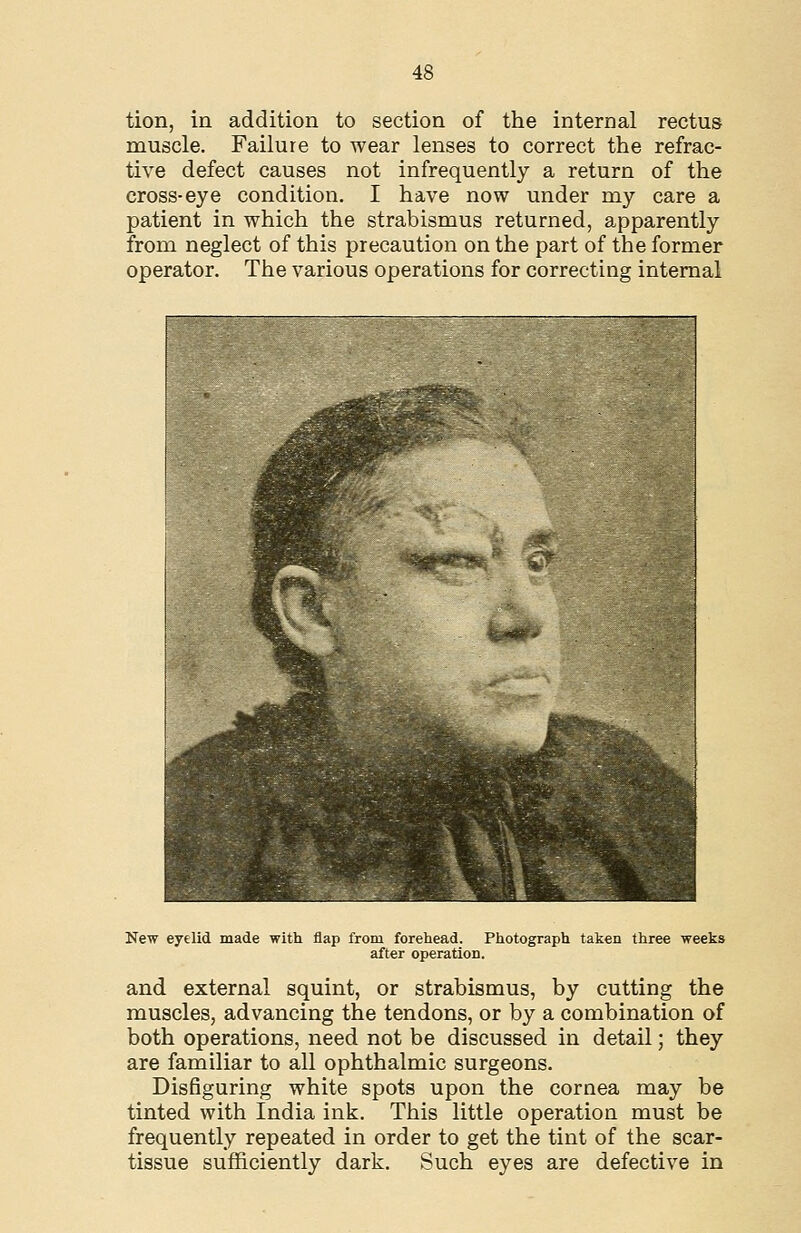 tion, in addition to section of the internal rectus muscle. Failure to wear lenses to correct the refrac- tive defect causes not infrequently a return of the cross-eye condition. I have now under my care a patient in which the strabismus returned, apparently from neglect of this precaution on the part of the former operator. The various operations for correcting internal New eyelid made with flap from forehead. Photograph taken three weeks after operation. and external squint, or strabismus, by cutting the muscles, advancing the tendons, or by a combination of both operations, need not be discussed in detail; they are familiar to all ophthalmic surgeons. Disfiguring white spots upon the cornea may be tinted with India ink. This little operation must be frequently repeated in order to get the tint of the scar- tissue sufficiently dark. Such eyes are defective in