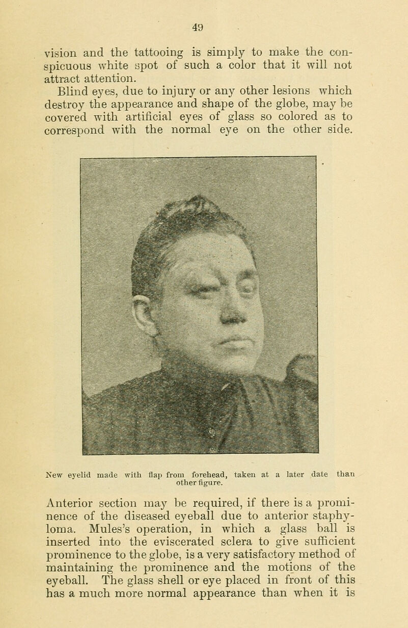 vision and the tattooing is simply to make the con- spicuous white spot of such a color that it will not attract attention. Blind eyes, due to injury or any other lesions which destroy the appearance and shape of the globe, may be covered with artificial eyes of glass so colored as to correspond with the normal eye on the other side. -,-:w'Sfe«.£l'?8«fi«ii3»»*-J New eyelid made with flap from forehead, takeu at a later date than other figure. Anterior section may be required, if there is a promi- nence of the diseased eyeball due to anterior staphy- loma. Mules's operation, in which a glass ball is inserted into the eviscerated sclera to give sufficient prominence to the globe, is a very satisfactory method of maintaining the prominence and the motions of the eyeball. The glass shell or eye placed in front of this has a much more normal appearance than when it is