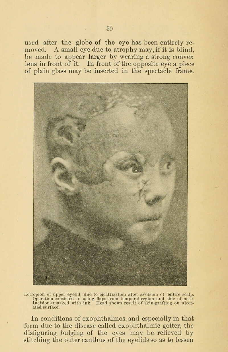 used after the globe of the eye has been entirely re- moved. A small eye due to atrophy may, if it is blind, be made to appear larger by wearing a strong convex lens in front of it. In front of the opposite eye a piece of plain glass may be inserted in the spectacle frame. Ectropion of upper eyelid, due to cicatrization after avulsion of entire scalp. Operation consisted in using flaps from temporal region and side of nose. Incisions marked with ink. Head shows result of skin-graftiog on ulcer- ated surface. In conditions of exophthalmos, and especially in that form due to the disease called exophthalmic goiter, the disfiguring bulging of the eyes may be relieved by stitching the outer canthus of the eyelids so as to lessen