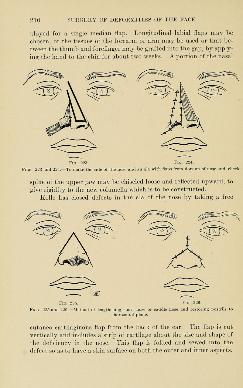 ployed for a single median flap. Longitudinal labial flaps may be chosen, or the tissues of the forearm or arm may be used or that be- tween the thumb and forefinger may be grafted into the gap, by apply- ing the hand to the chin for about two weeks. A portion of the nasal Fig. 223. Fig. 224. Figs. 223 and 224.—To make the side of the nose and an ala with flaps from dorsum of nose and cheek. spine of the upper jaw may be chiseled loose and reflected upward, to give rigidity to the new columella which is to be constructed. Kolle has closed defects in the ala of the nose by taking a free Fig. 225. Fig. 226. Figs. 225 and 226.—Method of lengthening short nose or saddle nose and restoring nostrils to horizontal plane. cutaneo-cartilaginous flap from the back of the ear. The flap is cut vertically and includes a strip of cartilage about the size and shape of the deficiency in the nose. This flap is folded and sewed into the defect so as to have a skin surface on both the outer and inner aspects.