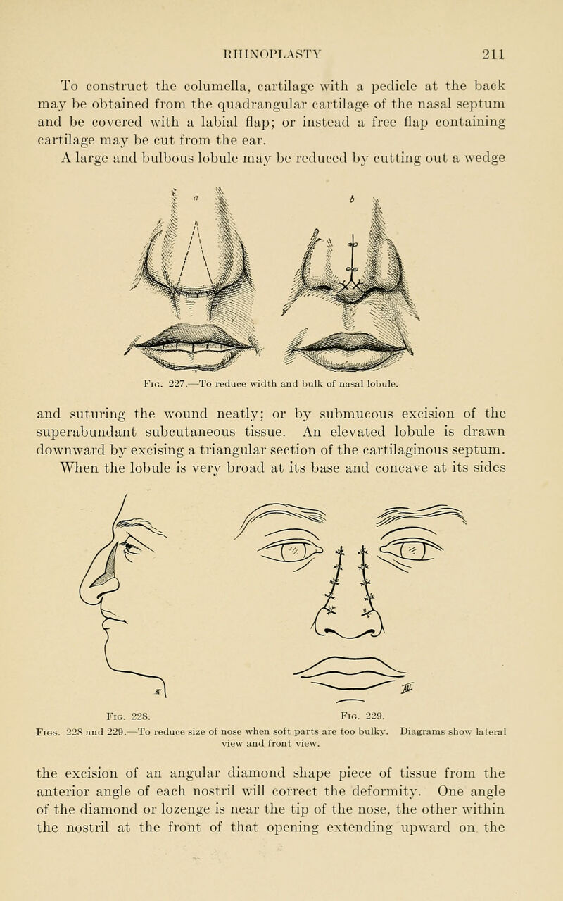 To construct the columella, cartilage with a pedicle at the back may be obtained from the quadrangular cartilage of the nasal septum and be covered with a labial flap; or instead a free flap containing cartilage may be cut from the ear. A large and bulbous lobule may be reduced Ijy cutting out a wedge Fig. 227.—To reduce width and bulk of nasal lobule. and suturing the wound neatly; or by submucous excision of the superabundant subcutaneous tissue. An elevated lobule is drawn downward by excising a triangular section of the cartilaginous septum. When the lobule is very broad at its base and concave at its sides Fig. 228. Fig. 229. Figs. 228 and 229.—To reduce size of nose when soft parts are too bulky. Diagrams show lateral view and front view. the excision of an angular diamond shape piece of tissue from the anterior angle of each nostril will correct the deformit}'. One angle of the diamond or lozenge is near the tip of the nose, the other within the nostril at the front of that opening extending upward on the