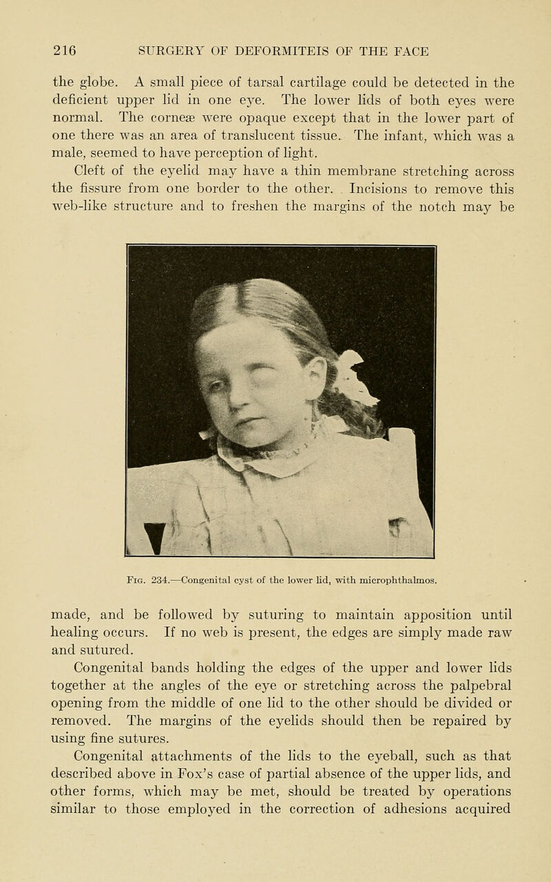 the globe. A small piece of tarsal cartilage could be detected in the deficient upper lid in one eye. The lower lids of both eyes were normal. The corneae were opaque except that in the lower part of one there was an area of translucent tissue. The infant, which was a male, seemed to have perception of light. Cleft of the eyelid may have a thin membrane stretching across the fissure from one border to the other. Incisions to remove this web-like structure and to freshen the margins of the notch may be f •^1^ ■ h ^B^ -C-.- '^«hK ^ \ ^ ■ if r ^ Fig. 234.—Congenital cyst of the lower lid, with microphthalmos. made, and be followed by suturing to maintain apposition until healing occurs. If no web is present, the edges are simply made raw and sutured. Congenital bands holding the edges of the upper and lower lids together at the angles of the eye or stretching across the palpebral opening from the middle of one lid to the other should be divided or removed. The margins of the eyelids should then be repaired by using fine sutures. Congenital attachments of the lids to the eyeball, such as that described above in Fox's case of partial absence of the upper lids, and other forms, which may be met, should be treated by operations similar to those employed in the correction of adhesions acquired