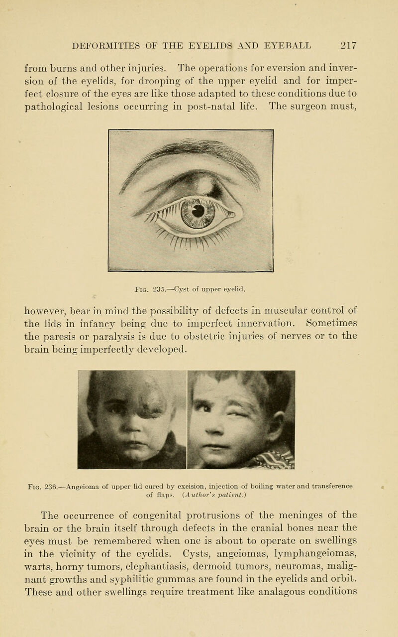 from burns and other injuries. The operations for eversion and inver- sion of the eyelids, for drooping of the upper eyelid and for imper- fect closure of the eyes are like those adapted to these conditions due to pathological lesions occurring in post-natal life. The surgeon must. Fig. 235.—Cyst of upper eyelid. however, bear in mind the possibility of defects in muscular control of the lids in infancy being due to imperfect innervation. Sometimes the paresis or paralysis is due to obstetric injuries of nerves or to the brain being imperfectly developed. Fig. 236. -Angeioma of upper lid cured by excision, injection of boiling water and transference of flaps. (Author's patient.) The occurrence of congenital protrusions of the meninges of the brain or the brain itself through defects in the cranial bones near the eyes must be remembered when one is about to operate on swellings in the vicinity of the eyelids. Cysts, angeiomas, lymphangeiomas, warts, horny tumors, elephantiasis, dermoid tumors, neuromas, malig- nant growths and sj'philitic gummas are found in the eyelids and orbit. These and other swellings require treatment like analagous conditions