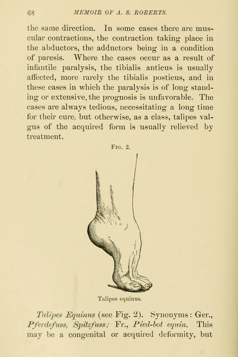 the same direction. In some cases there are mus- cular contractions, the contraction taking place in the abductors, the adductors being in a condition of paresis. Where the cases occur as a result of infantile paralysis, the tibialis anticus is usually affected, more rarely the tibialis posticus, and in these cases in which the paralysis is of long stand- ing or extensive, the prognosis is unfavorable. The cases are always tedious, necessitating a long time for their cure, but otherwise, as a class, talipes val- gus of the acquired form is usually relieved by treatment. Fig. 2. Talipes equinus. Talipes Equinus (see Fig. 2). Synonyms: Ger., Pferdefuss, Sjritzfuss; Fr., Pied-bot equin. This may be a congenital or acquired deformity, but