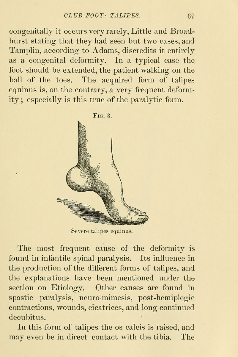 congenitally it occurs very rarely, Little and Broad- hurst stating that they had seen but two cases, and Tamplin, according to Adams, discredits it entirely as a congenital deformity. In a typical case the foot should be extended, the patient walking on the ball of the toes. The acquired form of talipes equinus is, on the contrary, a very frequent deform- ity; especially is this true of the paralytic form. Fig. 3. Severe talipes equinus. The most frequent cause of the deformity is found in infantile spinal paralysis. Its influence in the production of the different forms of talipes, and the explanations have been mentioned under the section on Etiology. Other causes are found in spastic paralysis, neuro-mimesis, post-hemiplegic contractions, wounds, cicatrices, and long-continued decubitus. In this form of talipes the os calcis is raised, and may even be in direct contact with the tibia. The