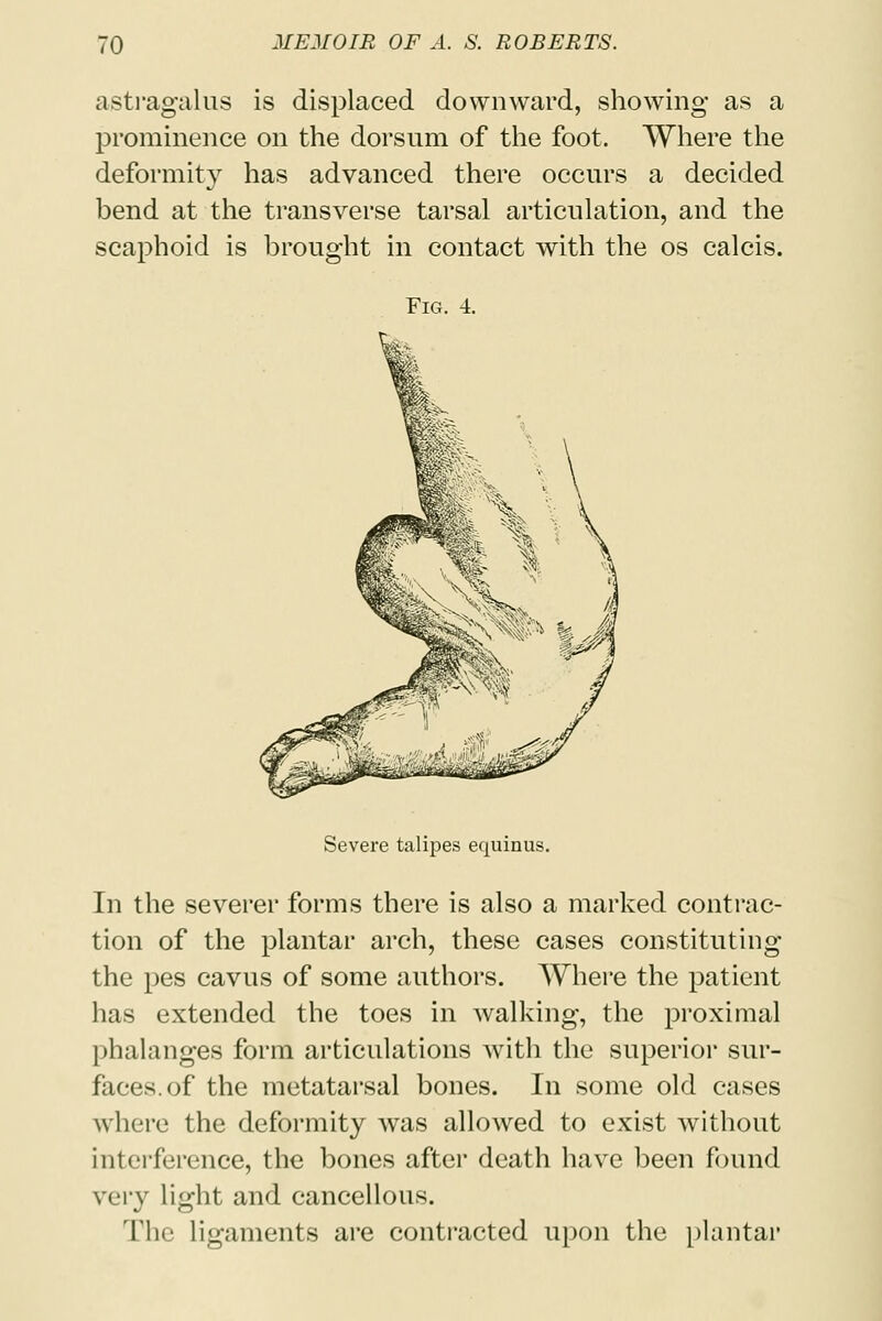 astragalus is displaced downward, showing as a prominence on the dorsum of the foot. Where the deformity has advanced there occurs a decided bend at the transverse tarsal articulation, and the scaphoid is brought in contact with the os calcis. Fig. 4. Severe talipes equinus. In the severer forms there is also a marked contrac- tion of the plantar arch, these cases constituting the pes cavus of some authors. Where the patient has extended the toes in walking, the proximal phalanges form articulations with the superior sur- faces, of the metatarsal bones. In some old cases where the deformity was allowed to exist without interference, the bones after death have been found very light and cancellous. The ligaments are contracted upon the plantar