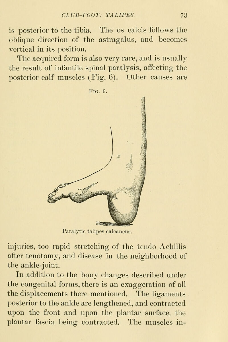 is posterior to the tibia. The os calcis follows the oblique direction of the astragalus, and becomes vertical in its position. The acquired form is also very rare, and is usually the result of infantile spinal paralysis, affecting the posterior calf muscles (Fig. 6). Other causes are Fig. 6. Paralytic talipes calcaneus. injuries, too rapid stretching of the tendo Achillis after tenotomy, and disease in the neighborhood of the ankle-joint. In addition to the bony changes described under the congenital forms, there is an exaggeration of all the displacements there mentioned. The ligaments posterior to the ankle are lengthened, and contracted upon the front and upon the plantar surface, the plantar fascia being contracted. The muscles in-