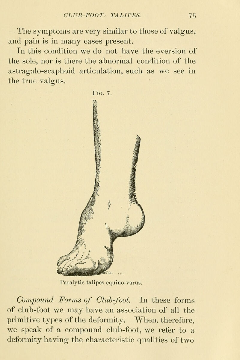 The symptoms are very similar to those of valgus, and pain is in many cases present. In this condition we do not have the eversion of the sole, nor is there the abnormal condition of the astragalo-scaphoid articulation, such as we see in the true valgus. Fig. 7. Paralytic talipes equino-varus. Compound Forms of Club-foot. In these forms of club-foot we may have an association of all the primitive types of the deformity. When, therefore, we speak of a compound club-foot, we refer to a deformity having the characteristic qualities of two