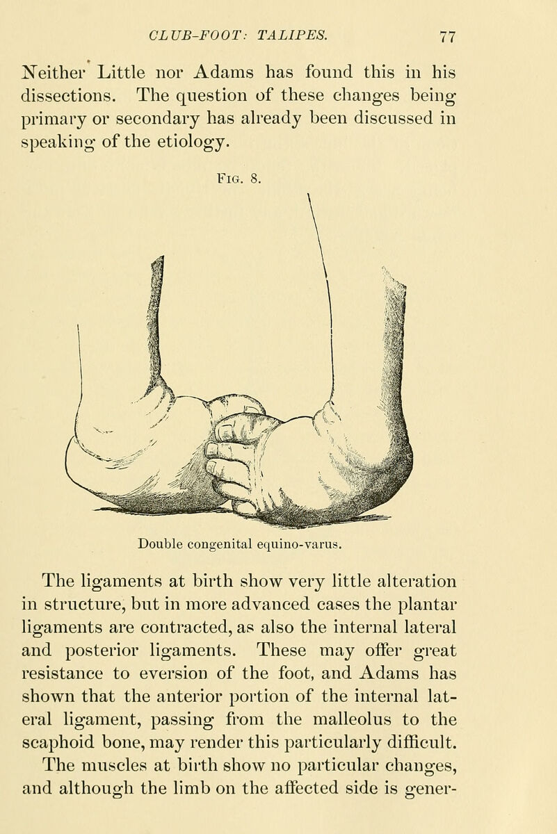 Neither Little nor Adams has found this in his dissections. The question of these changes being primary or secondary has already been discussed in speaking of the etiology. Fig. 8. Double congenital equino-varus. The ligaments at birth show very little alteration in structure, but in more advanced cases the plantar ligaments are contracted, as also the internal lateral and posterior ligaments. These may offer great resistance to eversion of the foot, and Adams has shown that the anterior portion of the internal lat- eral ligament, passing from the malleolus to the scaphoid bone, may render this particularly difficult. The muscles at birth show no particular changes, and although the limb on the affected side is gener-