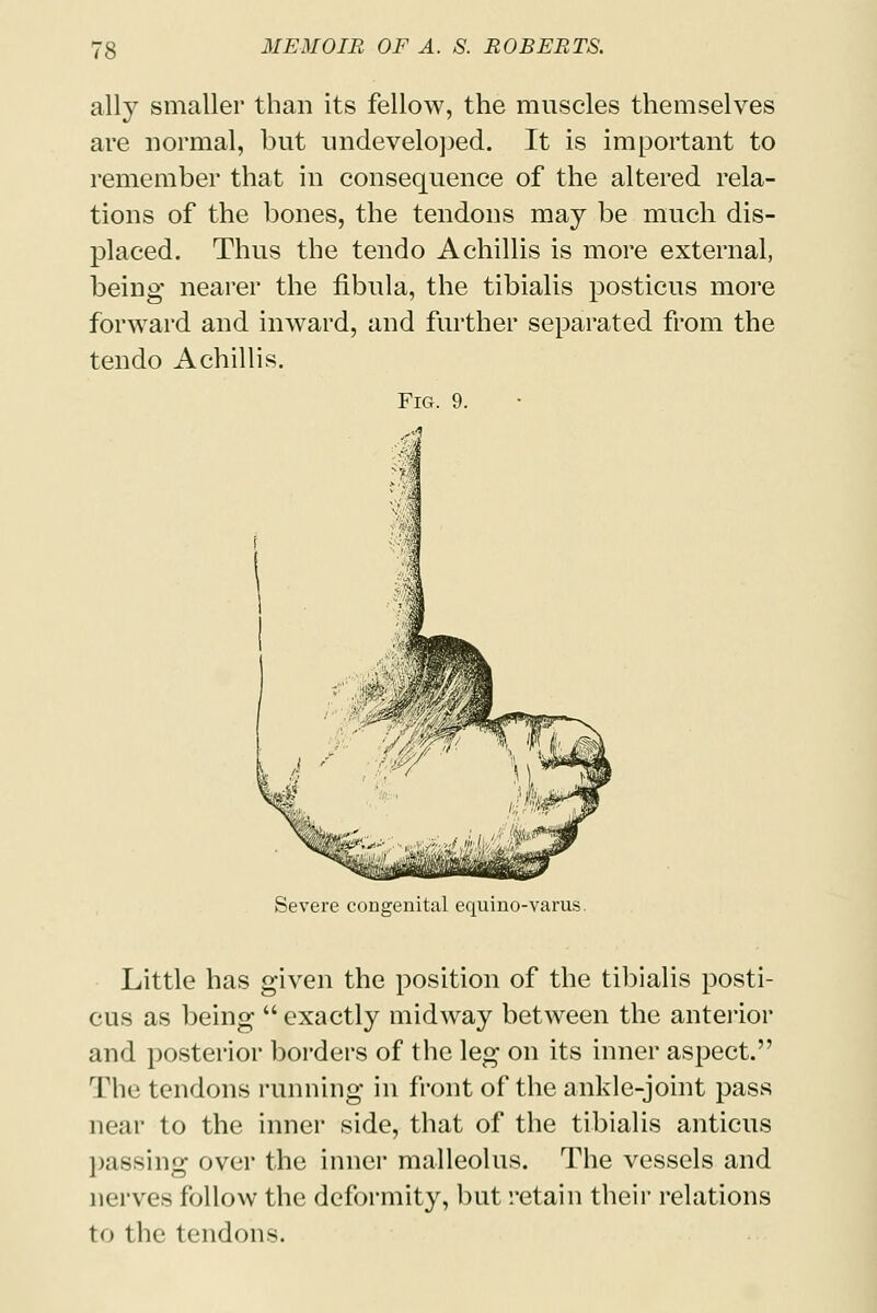 ally smaller than its fellow, the muscles themselves are normal, but undeveloped. It is important to remember that in consequence of the altered rela- tions of the bones, the tendons may be much dis- placed. Thus the tendo Achillis is more external, being nearer the fibula, the tibialis posticus more forward and inward, and further separated from the tendo Achillis. Fig. 9. Severe congenital equine-varus. Little has given the position of the tibialis posti- cus as being  exactly midway between the anterior and posterior borders of the leg on its inner aspect. The tendons running in front of the ankle-joint pass near to the inner side, that of the tibialis anticus pissing over the inner malleolus. The vessels and nerves follow the deformity, but retain their relations to the tendons.