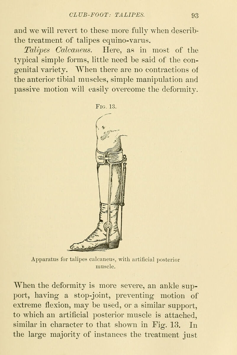 and we will revert to these more fully when describ- the treatment of talipes equino-varus. Talipes Calcaneus, Here, as in most of the typical simple forms, little need be said of the con- genital variety. When there are no contractions of the anterior tibial muscles, simple manipulation and passive motion will easily overcome the deformity. Fig. 13. Apparatus for talipes calcaneus, with artificial posterior muscle. When the deformity is more severe, an ankle sup- port, having a stop-joint, preventing motion of extreme flexion, may be used, or a similar support, to which an artificial posterior muscle is attached, similar in character to that shown in Fig. 13. In the large majority of instances the treatment just