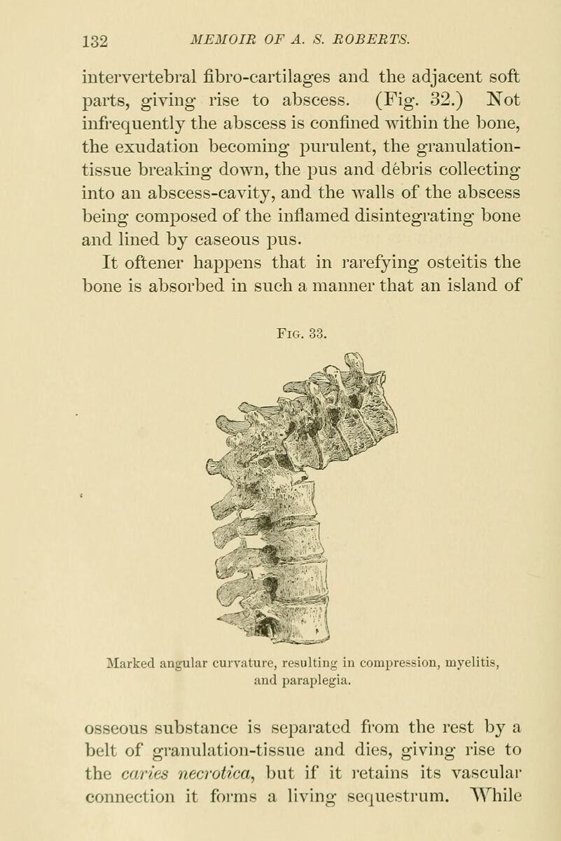 intervertebral fibro-cartilages and the adjacent soft parts, giving rise to abscess. (Fig. 32.) Not infrequently the abscess is confined within the bone, the exudation becoming purulent, the granulation- tissue breaking down, the pus and debris collecting into an abscess-cavity, and the walls of the abscess being composed of the inflamed disintegrating bone and lined by caseous pus. It oftener happens that in rarefying osteitis the bone is absorbed in such a manner that an island of Fig. 33. &t (■■■; l&. Marked angular curvature, resulting in compression, myelitis, and paraplegia. osseous substance is separated from the rest by a belt of granulation-tissue and dies, giving rise to the caries necrotica, but if it retains its vascular connection it forms a living sequestrum. While