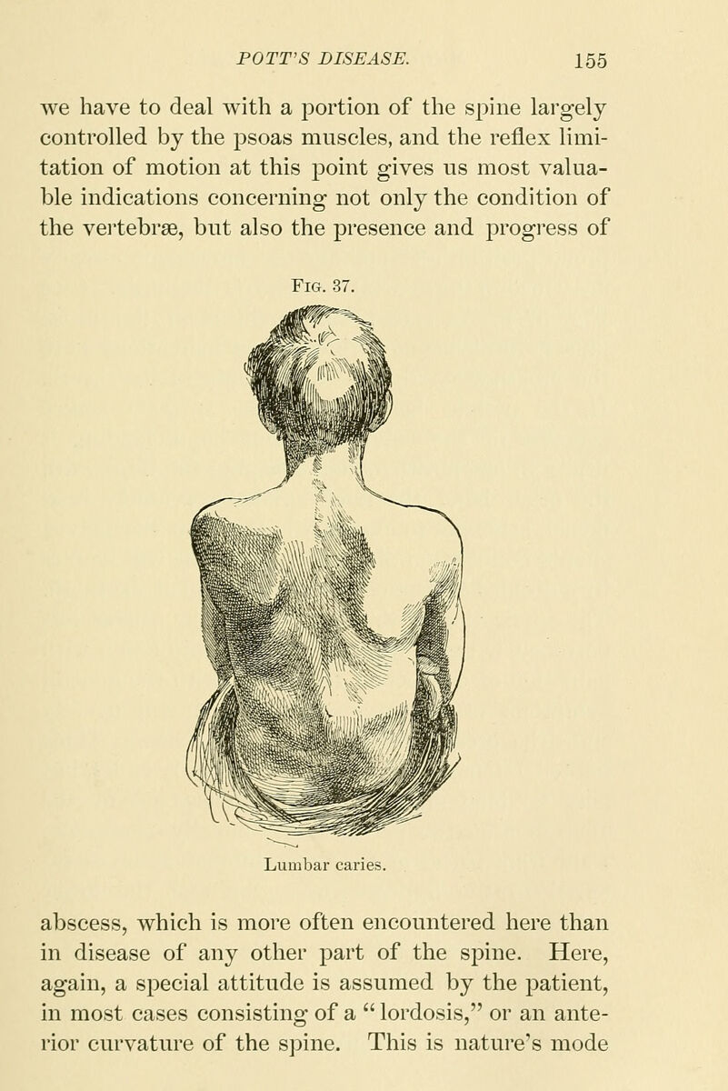 we have to deal with a portion of the spine largely controlled by the psoas muscles, and the reflex limi- tation of motion at this point gives us most valua- ble indications concerning not only the condition of the vertebrae, but also the presence and progress of Fig. 37. Lumbar caries. abscess, which is more often encountered here than in disease of any other part of the spine. Here, again, a special attitude is assumed by the patient, in most cases consisting of a  lordosis, or an ante- rior curvature of the spine. This is nature's mode