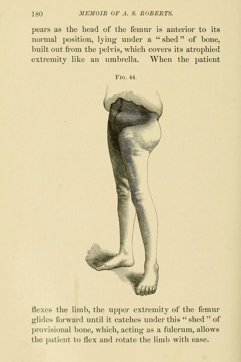 pears as the head of the femur is anterior to its normal position, lying under a shed of bone, built out from the pelvis, which covers its atrophied extremity like an umbrella. When the patient Fig. 44. flexes the limb, the upper extremity of the femur glides forward until it catches under this  shed  of provisional bone, which, acting as a fulcrum, allows the patient to flex and rotate the limb with ease.