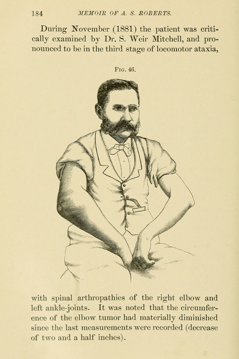 During November (1881) the patient was criti- cally examined by Dr. S. Weir Mitchell, and pro- nounced to be in the third stasre of locomotor ataxia, Fig. 46. with spinal arthropathies of the right elbow and left ankle-joints. It was noted that the circumfer- ence of the elbow tumor had materially diminished since the last measurements were recorded (decrease of two and a half inches).