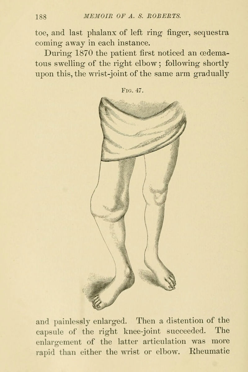 toe, and last phalanx of left ring finger, sequestra coming away in each instance. During 1870 the patient first noticed an cedema- tous swelling of the right elbow; following shortly upon this, the wrist-joint of the same arm gradually Fig. 47. and painlessly enlarged. Then a distention of the capsule of the right knee-joint succeeded. The enlargement of the latter articulation was more rapid than either the wrist or elbow. Rheumatic