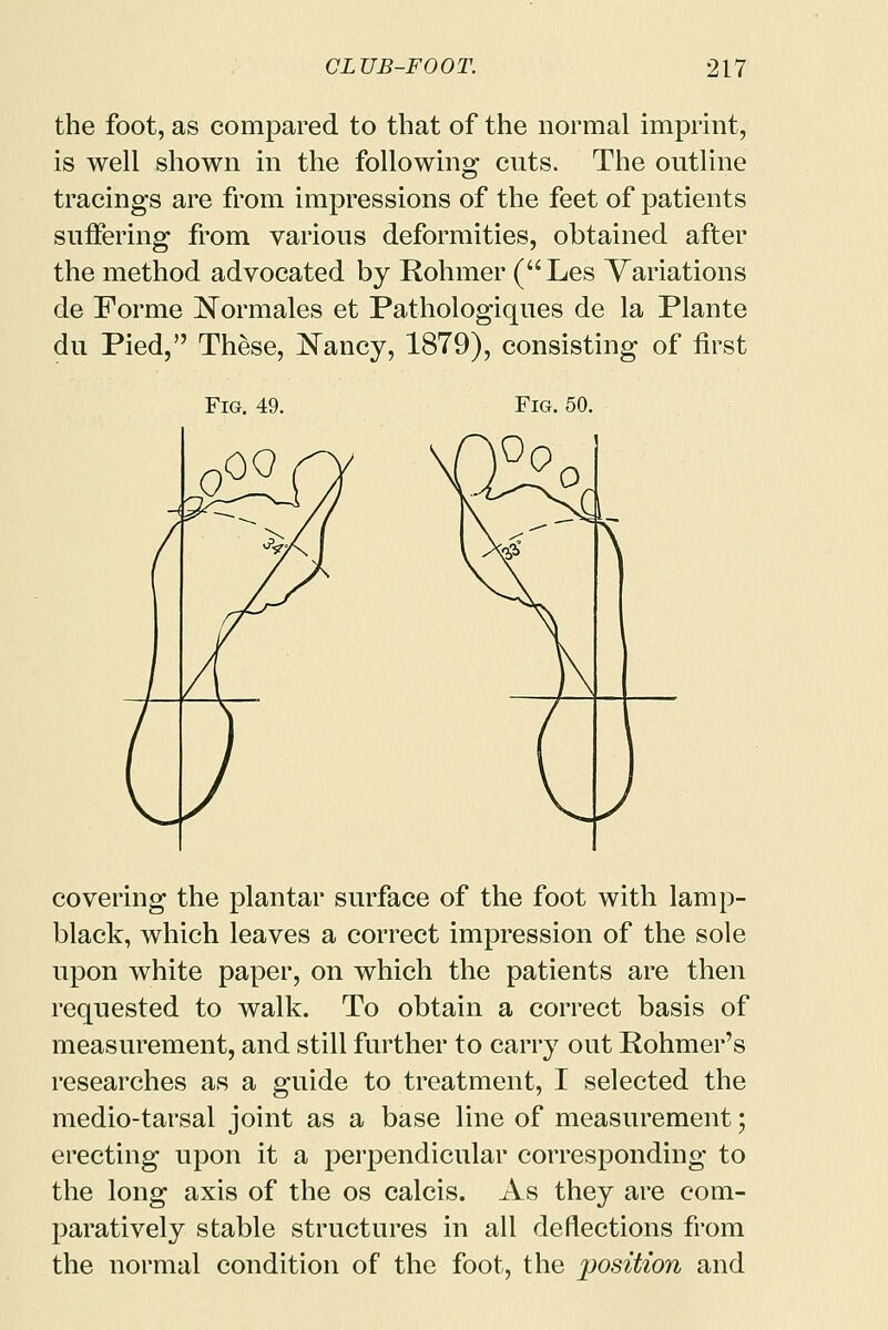 the foot, as compared to that of the normal imprint, is well shown in the following cuts. The outline tracings are from impressions of the feet of patients suffering from various deformities, obtained after the method advocated by Rohmer (Les Variations de Forme Normales et Pathologiques de la Plante du Pied, These, Nancy, 1879), consisting of first Fig. 50. covering the plantar surface of the foot with lamp- black, which leaves a correct impression of the sole upon white paper, on which the patients are then requested to walk. To obtain a correct basis of measurement, and still further to carry out Rohmer's researches as a guide to treatment, I selected the medio-tarsal joint as a base line of measurement; erecting upon it a perpendicular corresponding to the long axis of the os calcis. As they are com- paratively stable structures in all deflections from the normal condition of the foot, the position and