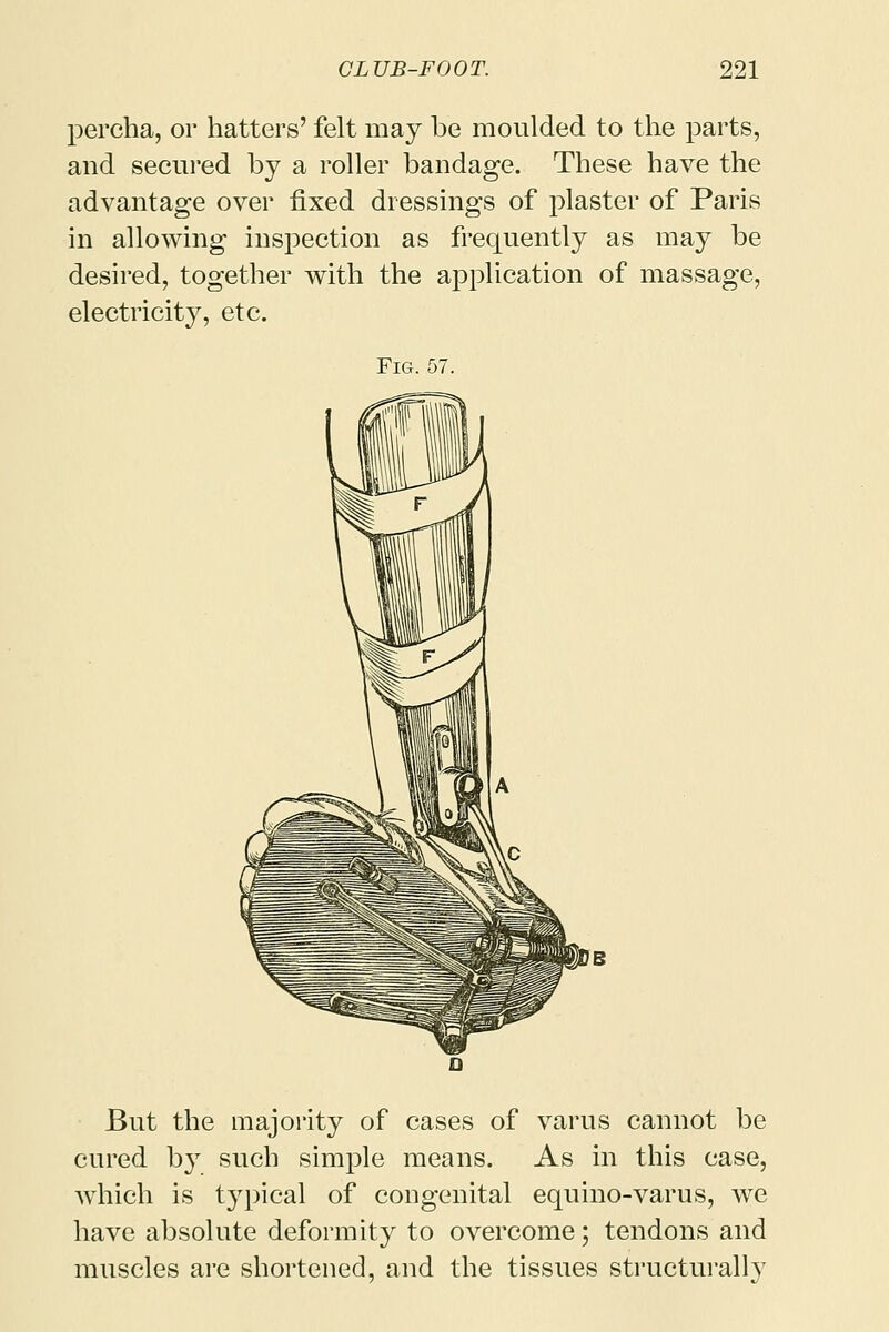 percha, or hatters' felt may be moulded to the parts, and secured by a roller bandage. These have the advantage over fixed dressings of plaster of Paris in allowing inspection as frequently as may be desired, together with the application of massage, electricity, etc. Fig. 57. But the majority of cases of varus cannot be cured by such simple means. As in this case, which is typical of congenital equino-varus, we have absolute deformity to overcome; tendons and muscles are shortened, and the tissues structurally