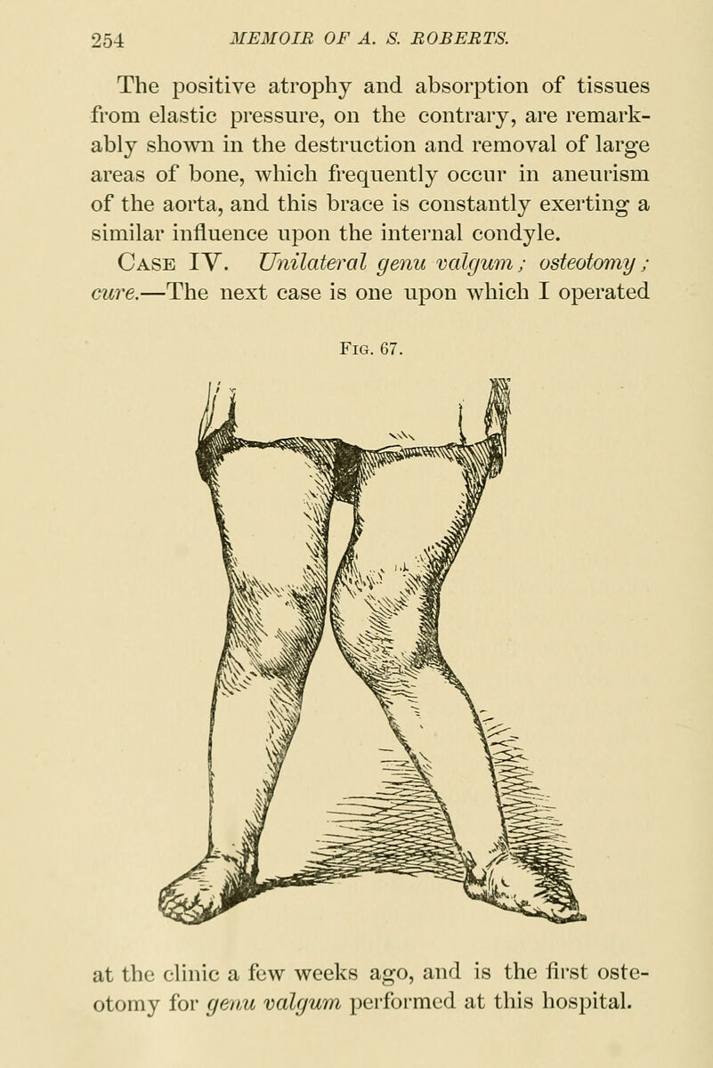 The positive atrophy and absorption of tissues from elastic pressure, on the contrary, are remark- ably shown in the destruction and removal of large areas of bone, which frequently occur in aneurism of the aorta, and this brace is constantly exerting a similar influence upon the internal condyle. Case IV. Unilateral genu valgum; osteotomy ; cure.—The next case is one upon which I operated Fig. 67. at the clinic a few weeks ago, and is the first oste- otomy for genu valgum performed at this hospital.