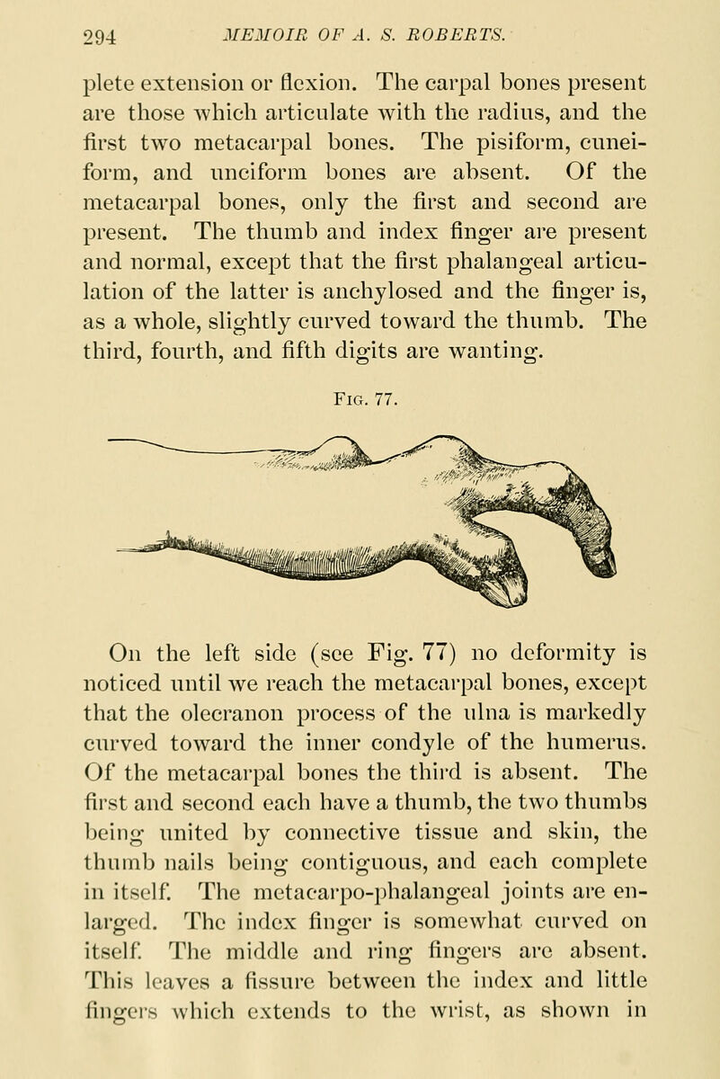 plete extension or flexion. The carpal bones present are those which articulate with the radius, and the first two metacarpal bones. The pisiform, cunei- form, and unciform bones are absent. Of the metacarpal bones, only the first and second are present. The thumb and index finger are present and normal, except that the first phalangeal articu- lation of the latter is anchylosed and the finger is, as a whole, slightly curved toward the thumb. The third, fourth, and fifth digits are wanting. Fig. 77. On the left side (see Fig. 77) no deformity is noticed until we reach the metacarpal bones, except that the olecranon process of the ulna is markedly curved toward the inner condyle of the humerus. Of the metacarpal bones the third is absent. The first and second each have a thumb, the two thumbs being united by connective tissue and skin, the thumb nails being contiguous, and each complete in itself. The metaearpo-phalangeal joints are en- larged. The index finger is somewhat curved on itself. The middle and ring fingers are absent. This leaves a fissure between the index and little fingers which extends to the wrist, as shown in