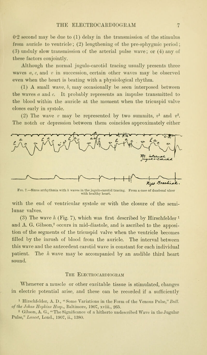 0*2 second may be due to (1) delay in the trausinissioii of the stimulus from auricle to ventricle; (2) lengthening of the pre-sphygmic period ; (3) unduly slow transmission of the arterial pulse wave; or (4) any of these factors conjointly. Although the nornuxl jugulo-carotid tracing usually presents three waves a, c, and r in succession, certain other waves may be observed even when the heart is beating with a physiological rhythm. (1) A small wave, h, may occasionally be seen interposed between the waves a and c. It probably represents an impulse transmitted to the blood within the auricle at the moment when the tricuspid valve closes early in systole. (2) The wave r may be represented by two summits, v^ and t'-. The notch or depression between them coincides approximately either .4^^ ^C yv_ yx^ ^rdu-Zu^. Fig. 7.—Sinus arrhj-thmia with h waves in tlie .jugtilo-carotid tracing. From a case of duodenal ulcer with healthy heart. with the end of ventricular systole or with the closure of the semi- lunar valves. (3) The wave h (Fig. 7), which was first described by Hirschfelder ^ and A. G. Gibson,- occurs in mid-diastole, and is ascribed to the apposi- tion of the segments of the tricuspid valve when the ventricle becomes filled by the inrush of blood from the auricle. The interval between this wave and the antecedent carotid wave is constant for each individual patient. The h wave may be accompanied by an audible third heart sound. The Electeocaediogram Whenever a muscle or other excitable tissue is stimulated, changes in electric potential arise, and these can be recorded if a sufficiently 1 Hirschfelder, A. D.,  Some Variations in the Form of the VenoiTS Pulse, Bull, of the Johns Hopkins Hosp., Baltimore, 1907, xviii., 265. 2 Gibson, A. G., The Significance of a hitherto undescribed Wave in the Jugular Pulse, Lancet, Lond., 1907, ii., 1380.