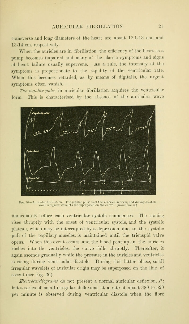 transverse and long diameters of the heart are about 12-1-13 cm., and 18-14 cm. respectively. When the auricles are in tibrillation the efficiency of the heart as a pump becomes impaired and many of the classic symptoms and signs of heart failure usually supervene. As a rule, the intensity of the symptoms is proportionate to the rapidity of the ventricular rate. When this becomes retarded, as by means of digitalis, the urgent symptoms often vanish. The jugular imhc in auricular fibrillation acquires the ventricular form. This is cliaracterised by the absence of the auricular wave Fio. 2(3.—Auricular fibrillation. The jugular pulse is of tlie ventricular form, and during diastole small irregular wavelets are superposed on the curve. {Heart, vol. ii.) immediately before each ventricular systole commences. The tracing rises abruptly with the onset of ventricular systole, and the systolic plateau, which may be interrupted by a depression due to the systolic pull of the papillary muscles, is maintained until the tricuspid valve opens. When this event occurs, and the blood pent up in the auricles rushes into the ventricles, the curve falls abruptly. Thereafter, it again ascends gradually while the pressure in the auricles and ventricles is rising during ventricular diastole. During this latter phase, small irregular wavelets of auricular origin may be superposed on the line of ascent (see Fig. 26). Electrocardiograms do not present a normal auricular deflexion, P; but a series of small irregular deflexions at a rate of about 380 to 520 per minute is observed during ventricular diastole when the fibre