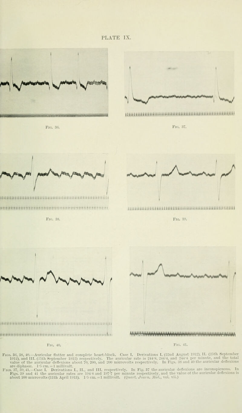 PLATK IX. ^^ Sf'^'^, V*^. V^ Fio. 30. Fin. 37. ^ A A 11111111111111111111111111111111111111111111111111111111111111111:1 'I '^ iiitJIiiiiiiiiiiiiiiii iMiiiiiiiiiiiiinii! uuiiuiuiiiiiiuiiiitmiiuuiuiuiuaaiuiuiuuuiiuui Fic. 38. Fig. 39. 'WV^ ^^V^^J'^^sJ^.^J^ '^w ( llllllllllllllllllllllllllllllllllllliiliiuiiMMiinninii.i. IlllMiiiliMiMiiiiiiiiiiniiiMiiiMMiitiiiiniiiiiiiiiiiiMiniliii Fics. 3.J, 3S, 4ri.—Auricular flutter and complete heart-block. Case I. Derivations I. (il-2nd August 1012), II. (I'oth September 1012), and III. (2oth September 1012) respectively. The auricular rate is 244-S, 244-4, and 244-4 per minute, and the total value of the auricular deflexions about 70, 200, and 200 microvolts respectively. In Figs. 3S and 40 the auricular deflexions aie diphasic. 1-5 em. = 1 millivolt. Figs. 37, 30.41.—Case I. Derivations I., II., and III. respectively. In Fig. 37 the auricular deflexions are inconspicuous. In Figs. 30 and 41 the auricular rates are 104 S and 107-7 per minute respectively, and the value of the auricular deflexions is