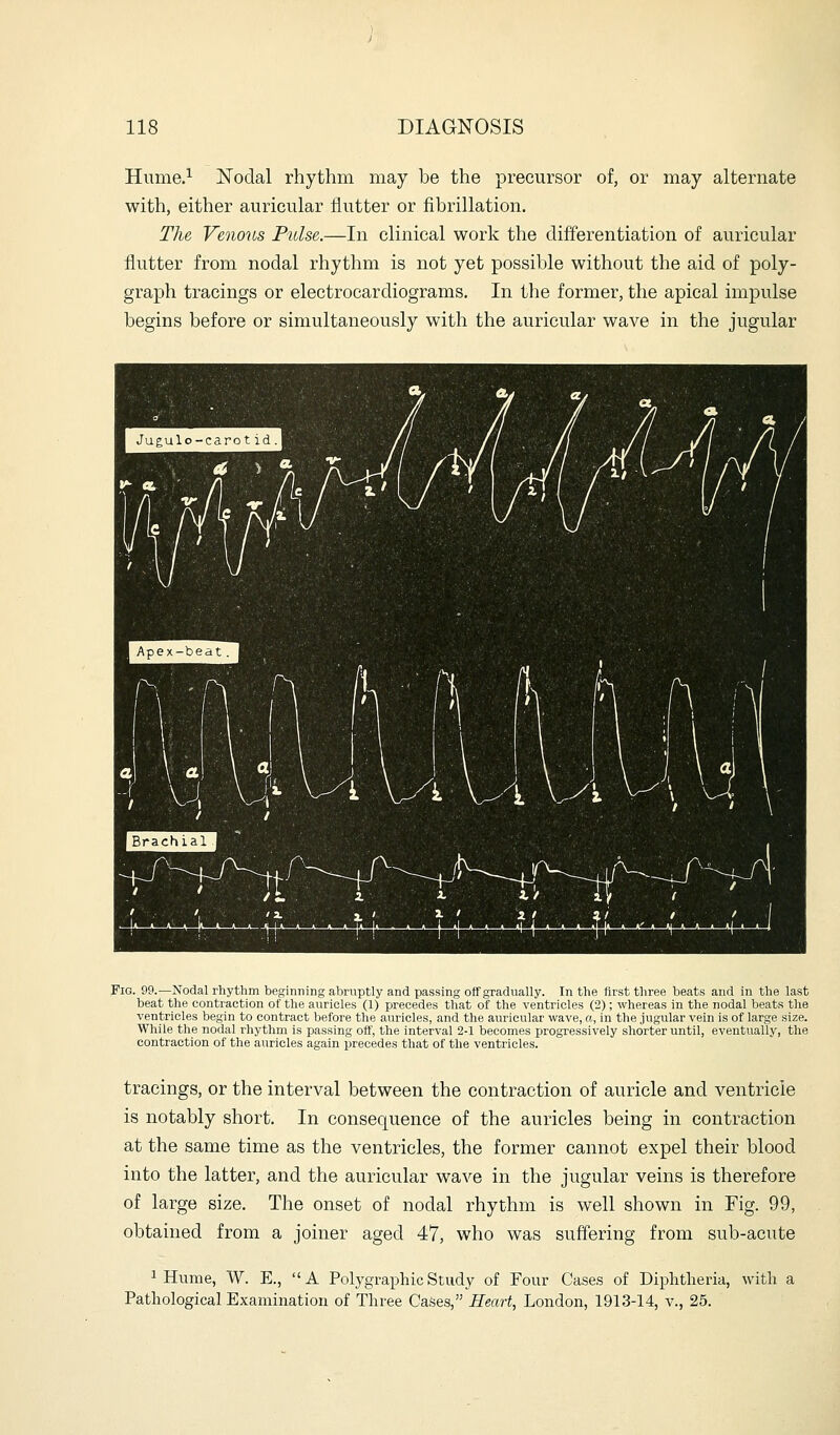 Hume.^ IsToclal rhythm may be the precursor of, or may alternate with, either auricular flutter or fibrillation. The Venous Pulse.—In clinical work the differentiation of auricular flutter from nodal rhythm is not yet possible without the aid of poly- graph tracings or electrocardiograms. In the former, the apical impulse begins before or simultaneously with the auricular wave in the jugular Fig. 99.—Nodal rhythm beginning abruptly and passing off gradually. In the first three beats and in the last beat the contraction of the auricles (1) precedes that of the ventricles (2); whereas in the nodal beats the ventricles begin to contract before the auricles, and the auricular wave, a, in the jugular vein is of large size. While the nodal rhythm is passing off, the interval 2-1 becomes progressively shorter until, eventually, the contraction of the auricles again precedes that of the ventricles. tracings, or the interval between the contraction of auricle and ventricle is notably short. In consequence of the auricles being in contraction at the same time as the ventricles, the former cannot expel their blood into the latter, and the auricular wave in the jugular veins is therefore of large size. The onset of nodal rhythm is well shown in Fig. 99, obtained from a joiner aged 47, who was suffering from sub-acute 1 Hume, W. E., A PolygraphicStudy of Four Cases of Diphtheria, with a Pathological Examination of Three Cases, Heart, London, 1913-14, v., 25.