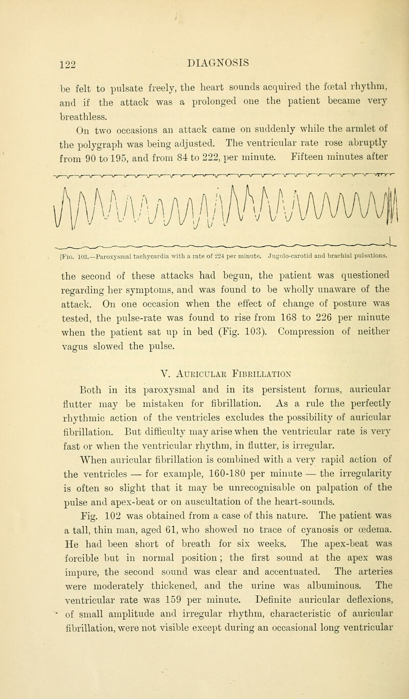 be felt to pulsate freely, the heart sounds acquired the fcetal rhythm, and if the attack was a prolonged one the patient became very breathless. On two occasions an attack came on suddenly while the armlet of the polygraph was being adjusted. The ventricular rate rose abruptly from 90 to 195, and from 84 to 222, per minute. Fifteen minutes after [Fig. 103.—Paroxysmal tachycardia witli a rate of 224 per minute. Jugulo-carotid and brachial pulsations. the second of these attacks had began, the patient was questioned regarding her symptoms, and was found to be wholly unaware of the attack. On one occasion when the effect of change of posture was tested, the pulse-rate was found to rise from 168 to 226 per minute when the patient sat up in bed (Fig. 103). Compression of neither vagus slowed the pulse. V. AUEICULAE FlBPJLLATIOX Both in its paroxysmal and in its persistent forms, auricular flutter may be mistaken for fibrillation. As a rule the perfectly rhythmic action of the ventricles excludes the possibility of auricular fibrillation. But difficulty may arise when the ventricular rate is very fast or when the ventricular rhythm, in flutter, is irregular. When auricular flbrillation is combined with a very rapid action of the ventricles — for example, 160-180 per minute — the irregularity is often so slight that it may be unrecognisable on palpation of the pulse and apex-beat or on auscultation of the heart-sounds. Fig. 102 was obtained from a case of this nature. The patient was a tall, thin man, aged 61, who showed no trace of cyanosis or oedema. He had been short of breath for six weeks. The apex-beat was forcible but in normal position; the flrst sound at the apex was impure, the second sound was clear and accentuated. The arteries were moderately thickened, and the urine was albuminous. The ventricular rate was 159 per minute. Definite auricular deflexions, ■ of small amplitude and irregular rhythm, characteristic of auricular fibrillation, were not visible except during an occasional long ventricular