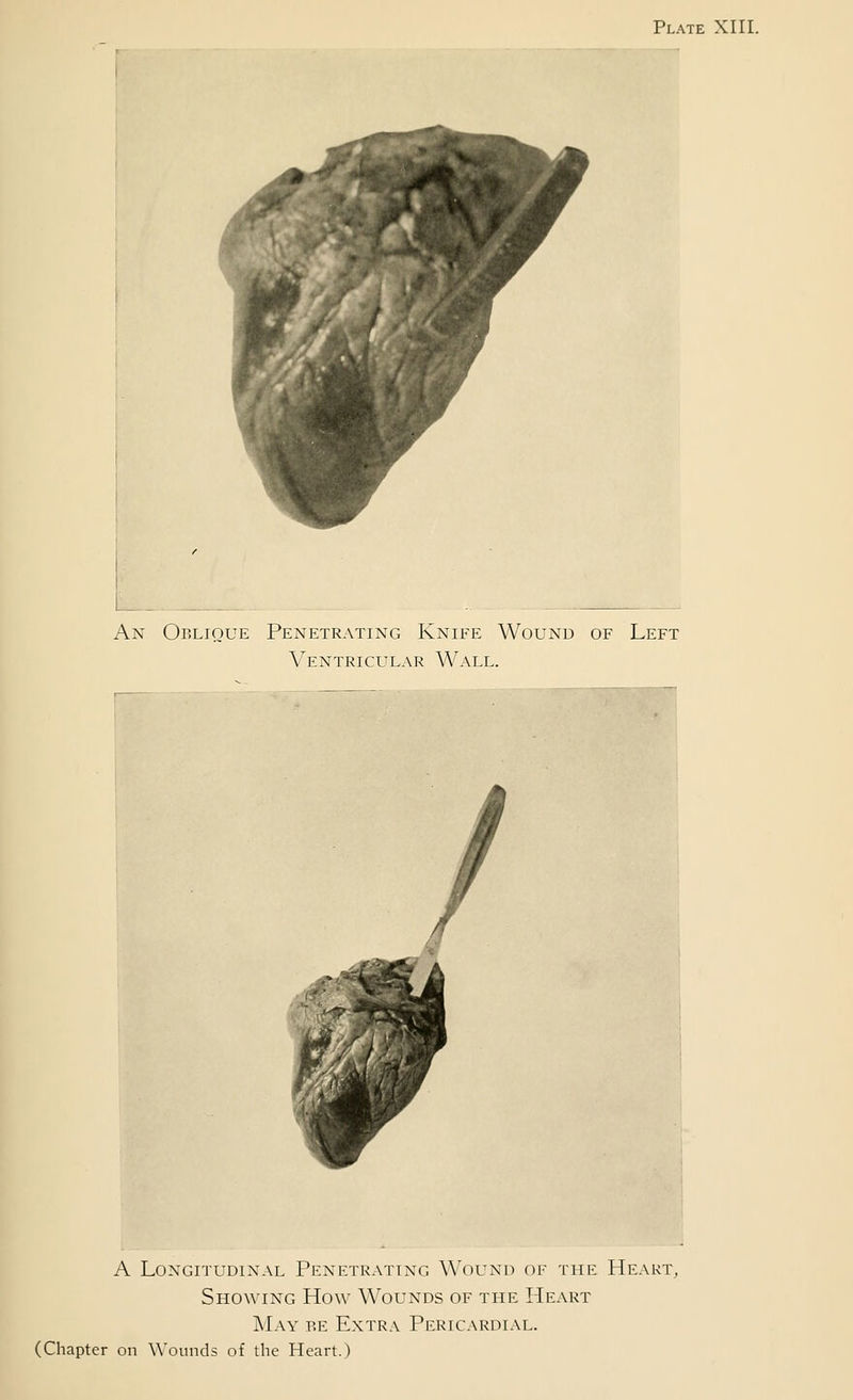 Plate XIII. An Oblique Penetrating Knife Wound of Left Ventricular Wall. A Longitudinal Penetrating Wound of the Heart, Showing How Wounds of the PIeart ]\L\Y BE Extra Pericardial. (Chapter on Wounds of the Heart.)