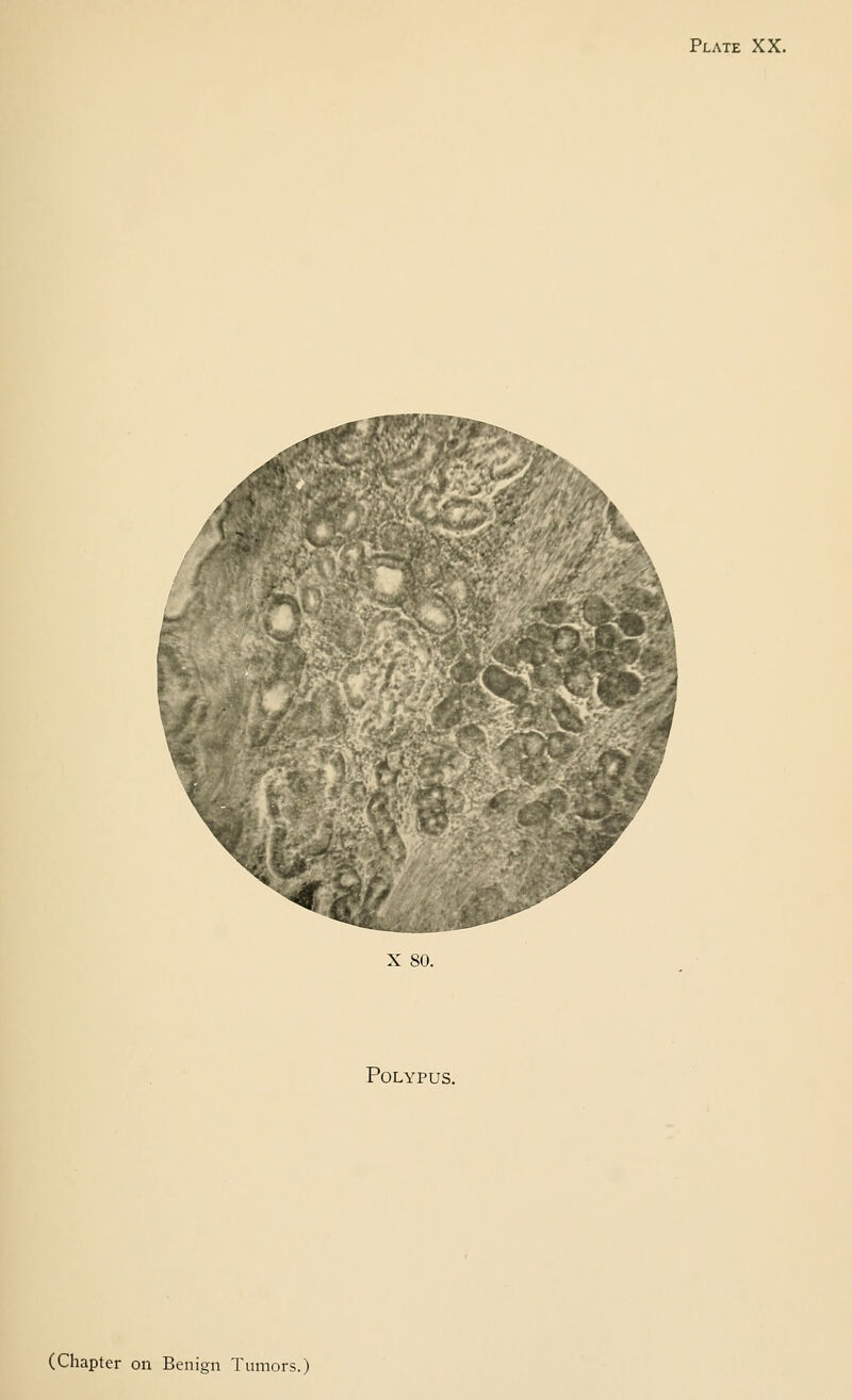 Plate XX. X 80. Polypus. (Chapter on Benign Tumors.)