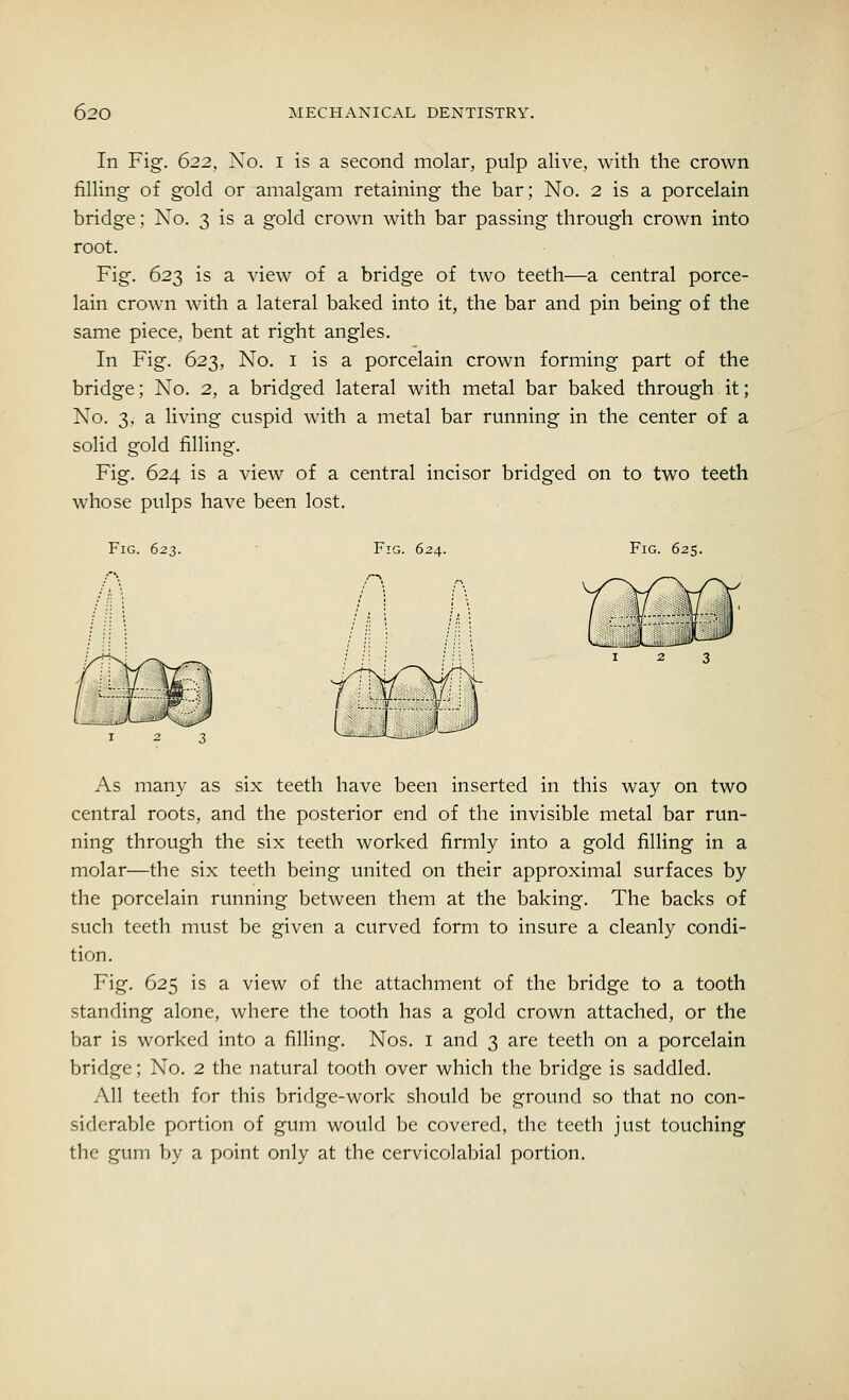 In Fig. 622. No. I is a second molar, pulp alive, with the crown filling of gold or amalgam retaining the bar; No. 2 is a porcelain bridge; No. 3 is a gold crown with bar passing through crown into root. Fig. 623 is a view of a bridge of two teeth—a central porce- lain crown with a lateral baked into it, the bar and pin being of the same piece, bent at right angles. In Fig. 623, No. 1 is a porcelain crown forming part of the bridge; No. 2, a bridged lateral with metal bar baked through it; No. 3, a living cuspid with a metal bar running in the center of a solid gold filling. Fig. 624 is a view of a central incisor bridged on to two teeth whose pulps have been lost. Fig. 623. Fig. 624. Fig. 625. As many as six teeth have been inserted in this way on two central roots, and the posterior end of the invisible metal bar run- ning through the six teeth worked firmly into a gold filling in a molar—the six teeth being united on their approximal surfaces by the porcelain running between them at the baking. The backs of such teeth must be given a curved form to insure a cleanly condi- tion. Fig. 625 is a view of the attachment of the bridge to a tooth standing alone, where the tooth has a gold crown attached, or the bar is worked into a filling. Nos. 1 and 3 are teeth on a porcelain bridge; No. 2 the natural tooth over which the bridge is saddled. All teeth for this bridge-work should be ground so that no con- siderable portion of gum would be covered, the teeth just touching the gum by a point only at the cervicolabial portion.