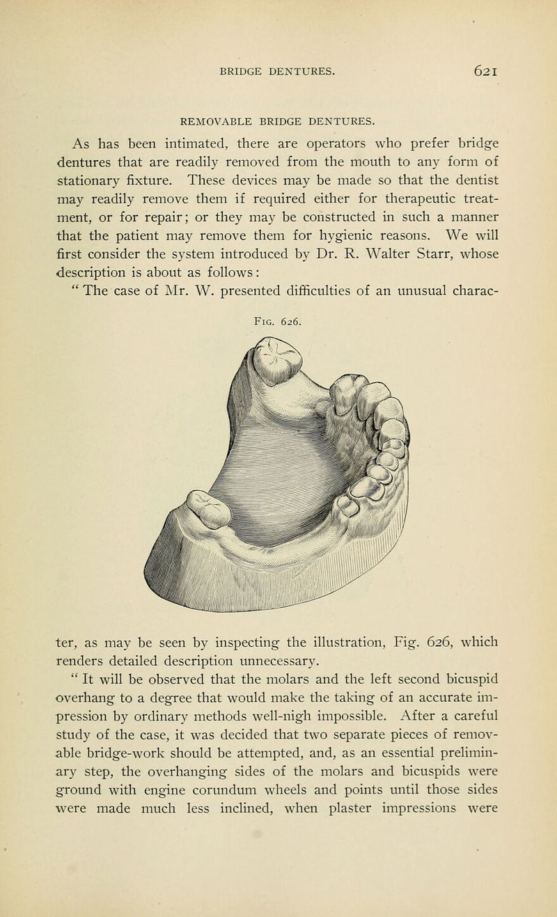 REMOVABLE BRIDGE DENTURES. As has been intimated, there are operators who prefer bridge dentures that are readily removed from the mouth to any form of stationary fixture. These devices may be made so that the dentist may readily remove them if required either for therapeutic treat- ment, or for repair; or they may be constructed in such a manner that the patient may remove them for hygienic reasons. We will first consider the system introduced by Dr. R. Walter Starr, whose description is about as follows:  The case of Mr. W. presented difficulties of an unusual charac- Fig. 626. ter, as may be seen by inspecting the illustration, Fig. 626, which renders detailed description unnecessary.  It will be observed that the molars and the left second bicuspid overhang to a degree that would make the taking of an accurate im- pression by ordinary methods well-nigh impossible. After a careful study of the case, it was decided that two separate pieces of remov- able bridge-work should be attempted, and, as an essential prelimin- ary step, the overhanging sides of the molars and bicuspids were ground with engine corundum wheels and points until those sides were made much less inclined, when plaster impressions were