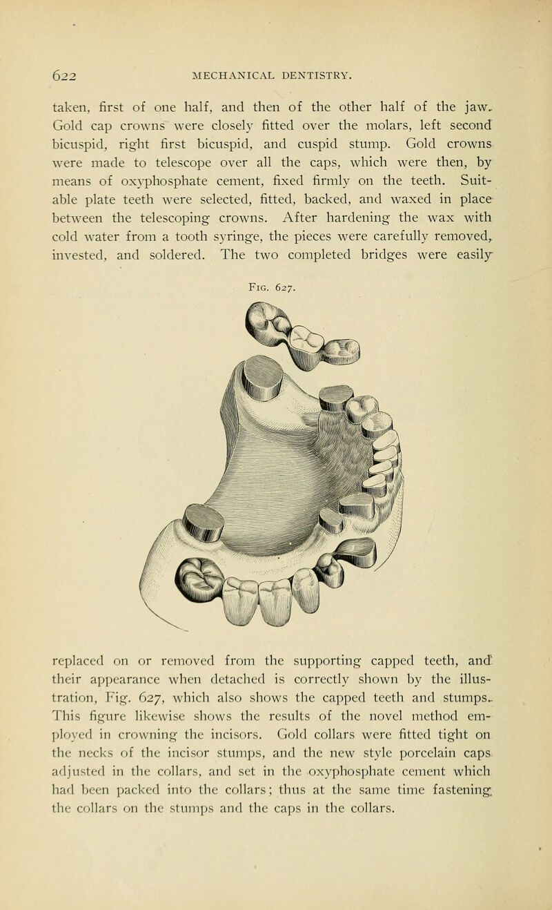 taken, first of one half, and then of the other half of the jaw. Gold cap crowns were closely fitted over the molars, left second bicuspid, right first bicuspid, and cuspid stump. Gold crowns were made to telescope over all the caps, which were then, by means of oxyphosphate cement, fixed firmly on the teeth. Suit- able plate teeth were selected, fitted, backed, and waxed in place between the telescoping crowns. After hardening the wax with cold water from a tooth syringe, the pieces were carefully removed,, invested, and soldered. The two completed bridges were easily Fig. 627. replaced on or removed from the supporting capped teeth, and their appearance when detached is correctly shown by the illus- tration, Fig. 627, which also shows the capped teeth and stumps.. This figure likewise shows the results of the novel method em- ployed in crowning the incisors. Gold collars were fitted tight on the necks of the incisor stumps, and the new style porcelain caps adjusted in the collars, and set in the oxyphosphate cement which had been packed into the collars; thus at the same time fastening the collars on the stumps and the caps in the collars.