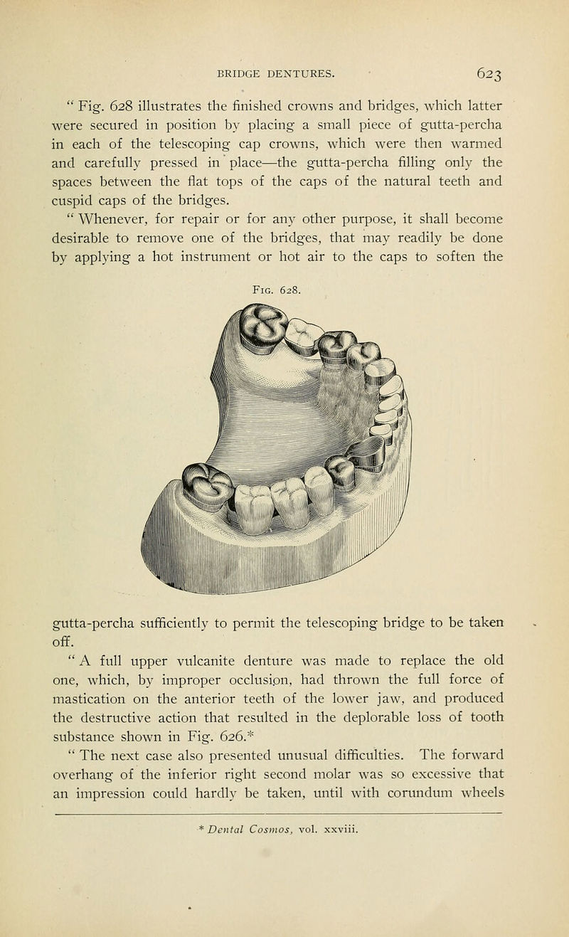  Fig. 628 illustrates the finished crowns and bridges, which latter were secured in position by placing a small piece of gutta-percha in each of the telescoping cap crowns, which were then warmed and carefully pressed in place—the gutta-percha filling only the spaces between the flat tops of the caps of the natural teeth and cuspid caps of the bridges.  Whenever, for repair or for any other purpose, it shall become desirable to remove one of the bridges, that may readily be done by applying a hot instrument or hot air to the caps to soften the Fig. 628. gutta-percha sufficiently to permit the telescoping bridge to be taken off.  A full upper vulcanite denture was made to replace the old one, which, by improper occlusion, had thrown the full force of mastication on the anterior teeth of the lower jaw, and produced the destructive action that resulted in the deplorable loss of tooth substance shown in Fig. 626.*  The next case also presented unusual difficulties. The forward overhang of the inferior right second molar was so excessive that an impression could hardly be taken, until with corundum wheels * Dental Cosmos, vol. xxviii.