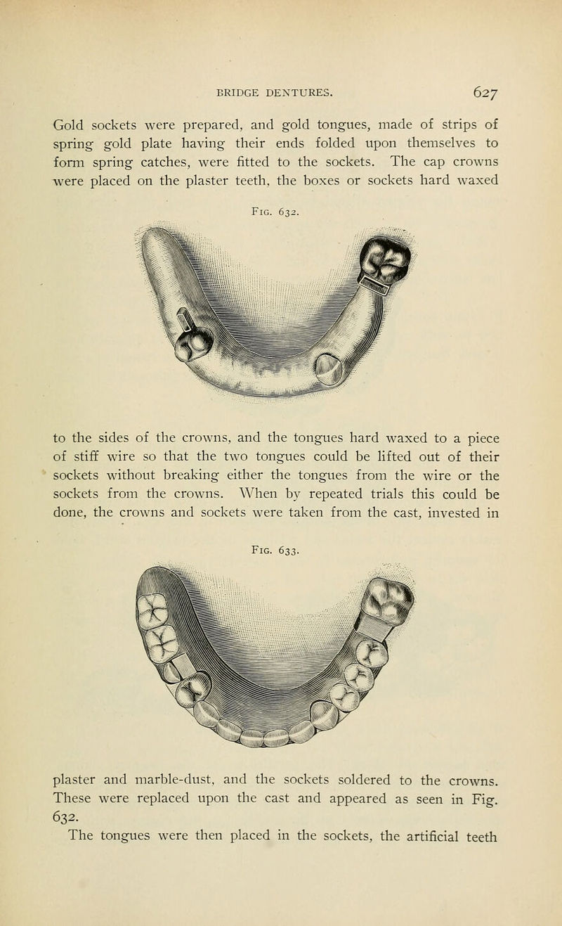 Gold sockets were prepared, and gold tongues, made of strips of spring gold plate having their ends folded upon themselves to form spring catches, were fitted to the sockets. The cap crowns were placed on the plaster teeth, the boxes or sockets hard waxed Fig. 632. to the sides of the crowns, and the tongues hard waxed to a piece of stiff wire so that the two tongues could be lifted out of their sockets without breaking either the tongues from the wire or the sockets from the crowns. When by repeated trials this could be done, the crowns and sockets were taken from the cast, invested in Fig. 633. plaster and marble-dust, and the sockets soldered to the crowns. These were replaced upon the cast and appeared as seen in Fig. 632. The tongues were then placed in the sockets, the artificial teeth