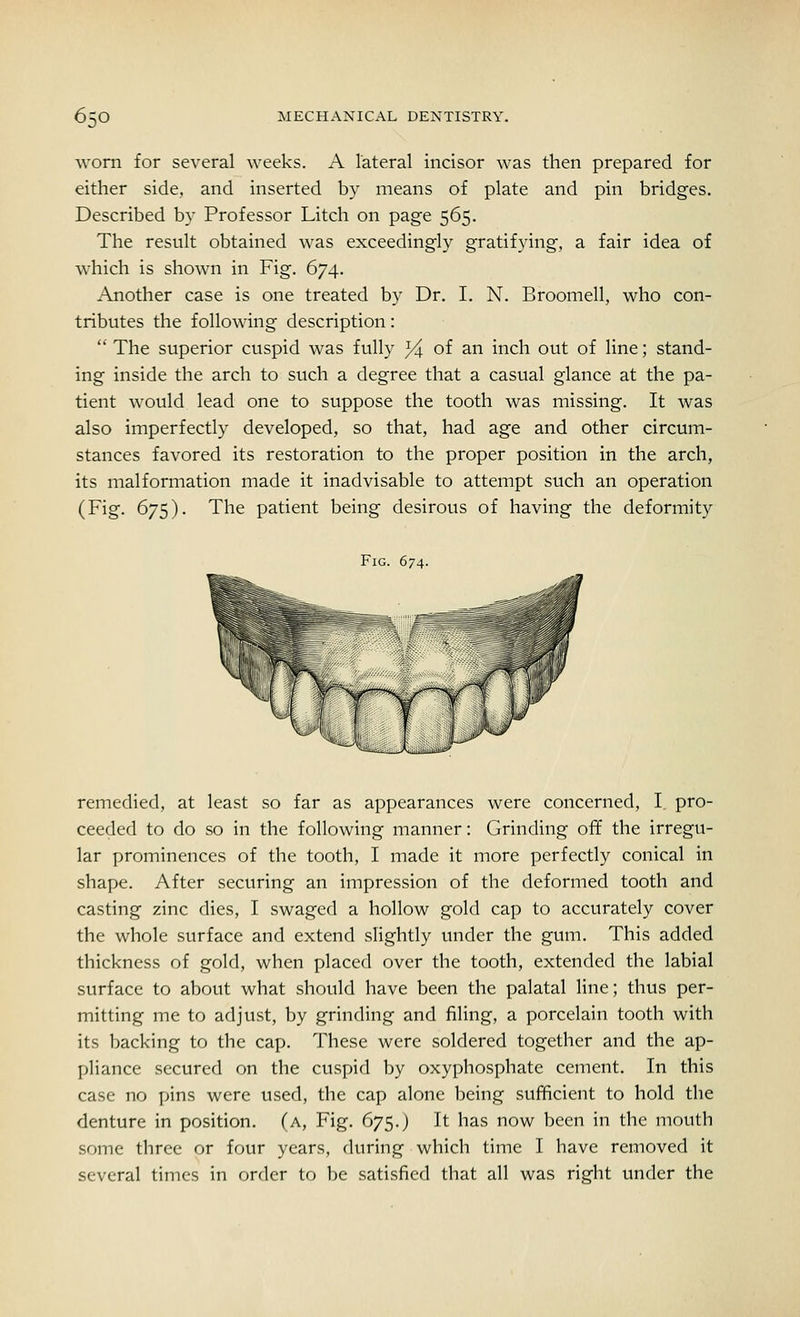 worn for several weeks. A lateral incisor was then prepared for either side, and inserted by means of plate and pin bridges. Described by Professor Litch on page 565. The result obtained was exceedingly gratifying, a fair idea of which is shown in Fig. 674. Another case is one treated by Dr. I. N. Broomell, who con- tributes the following description:  The superior cuspid was fully Y\ of an inch out of line; stand- ing inside the arch to such a degree that a casual glance at the pa- tient would lead one to suppose the tooth was missing. It was also imperfectly developed, so that, had age and other circum- stances favored its restoration to the proper position in the arch, its malformation made it inadvisable to attempt such an operation (Fig. 675). The patient being desirous of having the deformity Fig. 674. remedied, at least so far as appearances were concerned, I pro- ceeded to do so in the following manner: Grinding off the irregu- lar prominences of the tooth, I made it more perfectly conical in shape. After securing an impression of the deformed tooth and casting zinc dies, I swaged a hollow gold cap to accurately cover the whole surface and extend slightly under the gum. This added thickness of gold, when placed over the tooth, extended the labial surface to about what should have been the palatal line; thus per- mitting me to adjust, by grinding and filing, a porcelain tooth with its backing to the cap. These were soldered together and the ap- pliance secured on the cuspid by oxyphosphate cement. In this case no pins were used, the cap alone being sufficient to hold the denture in position, (a, Fig. 675.) It has now been in the mouth some three or four years, during which time I have removed it several times in order to be satisfied that all was right under the