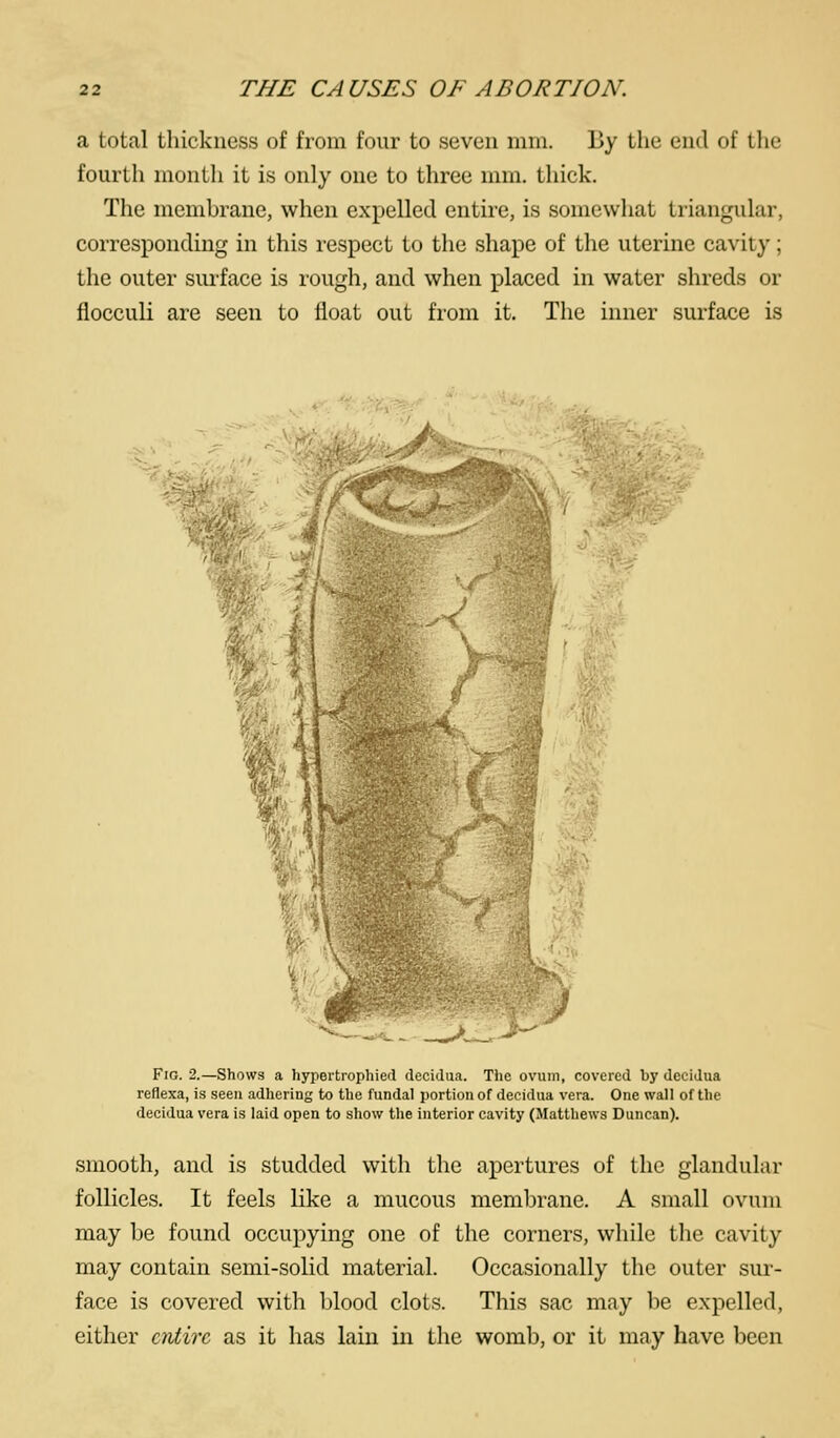 a total thickness of from four to seven mm. By the end of tlie fourth montli it is only one to three mm. thick. The membrane, when expelled entire, is somewhat triangular, corresponding in this respect to the shape of the uterine cavity; the outer surface is rough, and when placed in water shreds or flocculi are seen to float out from it. The inner surface is %T1»/'- Fig. 2.—Shows a hypertrophied decidua. The ovum, covered by deciJua reflexa, is seen adhering to the fundal portion of decidua vera. One wall of tlie decidua vera is laid open to show the interior cavity (Matthews Duncan). smooth, and is studded with the apertures of the glandular follicles. It feels like a mucous membrane. A small ovum may be found occupying one of the corners, while tlie cavity may contain semi-solid material. Occasionally the outer sur- face is covered with blood clots. This sac may be expelled, either entire as it has lain in the womb, or it may have been