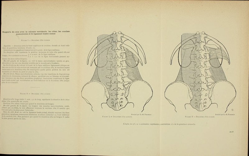 Rapports du rein avec la colonne vertébrale, les côtes, les couches musculaires et le ligament lombo-costal Itinguc. Son cxtriïmiKÎ s Sqnckttc. — Distance entre le bord supérieur de onzième dorsale et bord infé- icur dequnlrîcnic lombaire i8 cent. 1/2. L'cxirémité des apophyses tramverses est à 4 cent, de la ligne médiane. La douzième côte représente la position moyenne de cette côte quand elle est ( h 10 cent, de la ligne médiane. I â 3 1/2 de la ligne horizontale passant au- dessus des deux crûtes iliaques. Du côté gauche de la figure, on voit la masse sacro-lombaire teintée en gris, débordée en bas sur une étendue notable parle mn^cXc carré lombaire. Le bord externe du rein est ft 8 cent, de la ligne médiane légèrement oblique en bas, une moitié du rein environ est masquée par la onzième côte, le onzième espace intercostal et la douzième côte. On rcmarquern quelle petite portion du rein est accessible tn dehors du carré et sous la côte. . Du coté droit. Masse sacro-lombaire enlevée, vue des insertions de raponévrose moyenne du transverse, naissant de chaque apophyse par un faisceau en éventail. Les l'aisccnux nés des deux premières apophyses iransvcrses constituent le liga- ment lombo-costal qui va s'atiacher au bord inférieur de la douzième côte jusque près de s tiun de la dou- Dou^iniic côte large étalée 5 cent. 1/^ de long, représente la zième côte quand elle est courte. Onzième cùie même trajet que quand la douzième est longu Du côté gauche de la figure. La largeur des muscles sai n'étant pas modifiée, le rein affleurant toujours la l'on aura plus de place pour l'atteindre. Mais du côté droit on voit le ligament lombo-costal, détaché toujours des deux premières apophyses transverses lombaires et allant s'attacher au bord inférieur de la onzième côte. Plus puissant que quand In douzième côte est longue il cache la plus grande partie du reïn. iicro-lombaire. c côte, il semble FiCL-RE I. — Douzii Figure II — Douzi