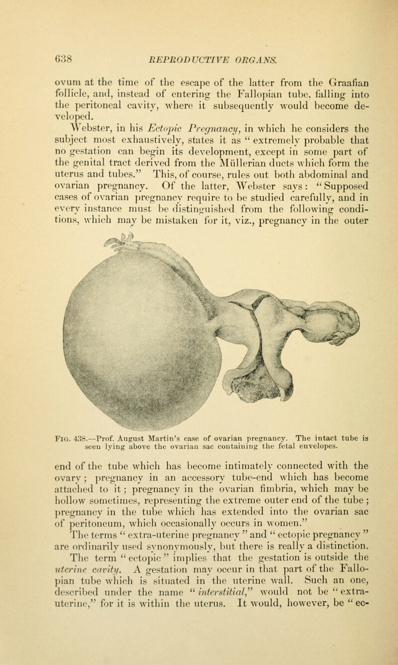 ovum at the time of the escajie of the hitter from tlie Graafian follicle, and, instead of entering the Fallopian tube, falling into the peritoneal cavity, where it subsequently would become de- veloped. Webster, in his Ectopic Pregnancy, in which he considers the subject most exhaustively, states it as  extremely probable that no gestation can begin its development, except in some part of the genital tract derived from the Miillerian ducts which form the uterus and tubes. This, of course, rules out both abdominal and ovarian pregnancy. Of the latter, Webster says :  Supposed cases of ovarian pregnancy require to be studied carefully, and in every instance must be distinguished from the following condi- tions, which may be mistaken for it, viz., pregnancy in the outer i.>y Fig. 438.—Prof. August Martin's case of ovarian pregnancy. The intact tube is seen lying above the ovarian sac containing the fetal envelopes. end of the tube which has become intimately connected with the ovary ; pregnancy in an accessory tube-end which has become attached to it; pregnancy in the ovarian fimbria, which may be hollow sometimes, representing the extreme outer end of the tube ; pregnancy in the tube which has extended into the ovarian sac of peritoneum, which occasionally occurs in women. The terms  extra-uterine pregnancy  and  ectopic pregnancy  are ordinarily used synonymously, but there is really a distinction. The term  ectopic  implies that the gestation is outside the uterine cavity. A gestation may occur in that part of the Fallo- pian tube which is situated in the uterine wall. Such an one, described under the name  interstitial,^^ would not be  extra- uterine, for it is within the uterus. It would, however, be  ec-